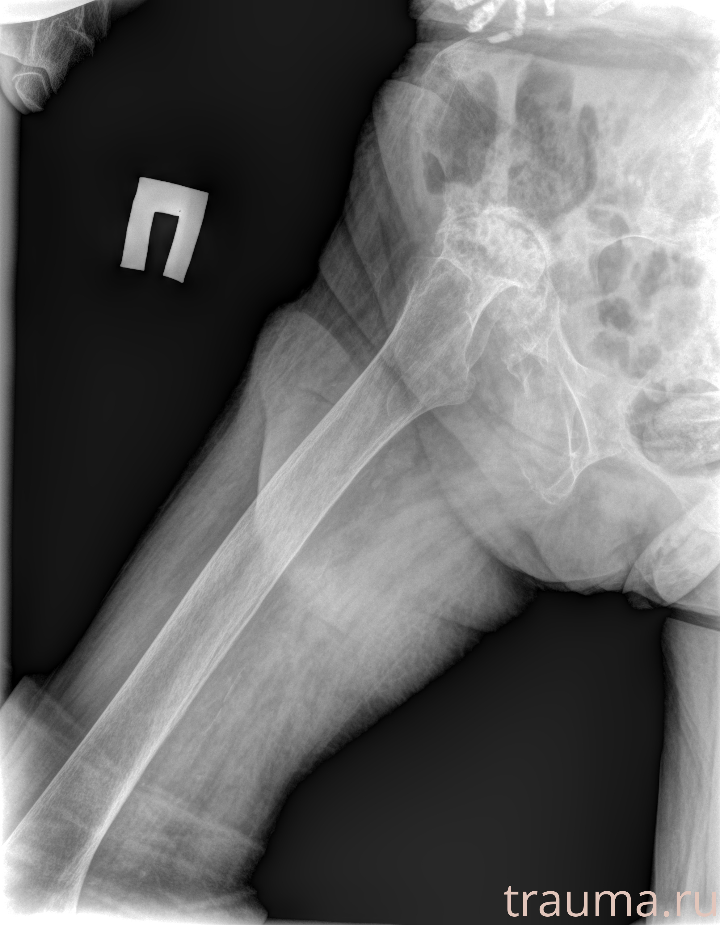 Рентген на дому: по вашему адресу приезжает врач-рентгенолог, травматолог-ортопед с мобильным рентгеновским аппаратом, проводит диагностику травмы или заболевания, делает необходимые рентгенограммы, дает рекомендации по дальнейшему лечению. Получить качественные снимки в домашних условиях возможно благодаря уникальной методике, разработанной МосРентген Центром для института  Склифосовского