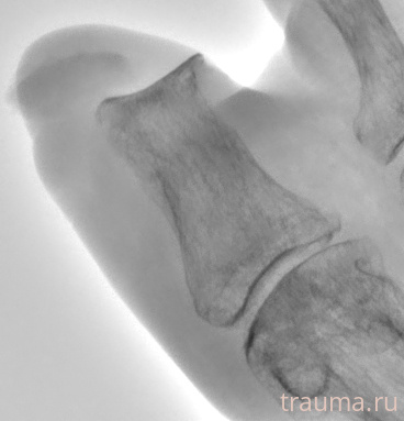 Рентген на дому: по вашему адресу приезжает врач-рентгенолог, травматолог-ортопед с мобильным рентгеновским аппаратом, проводит диагностику травмы или заболевания, делает необходимые рентгенограммы, дает рекомендации по дальнейшему лечению. Получить качественные снимки в домашних условиях возможно благодаря уникальной методике, разработанной МосРентген Центром для института  Склифосовского