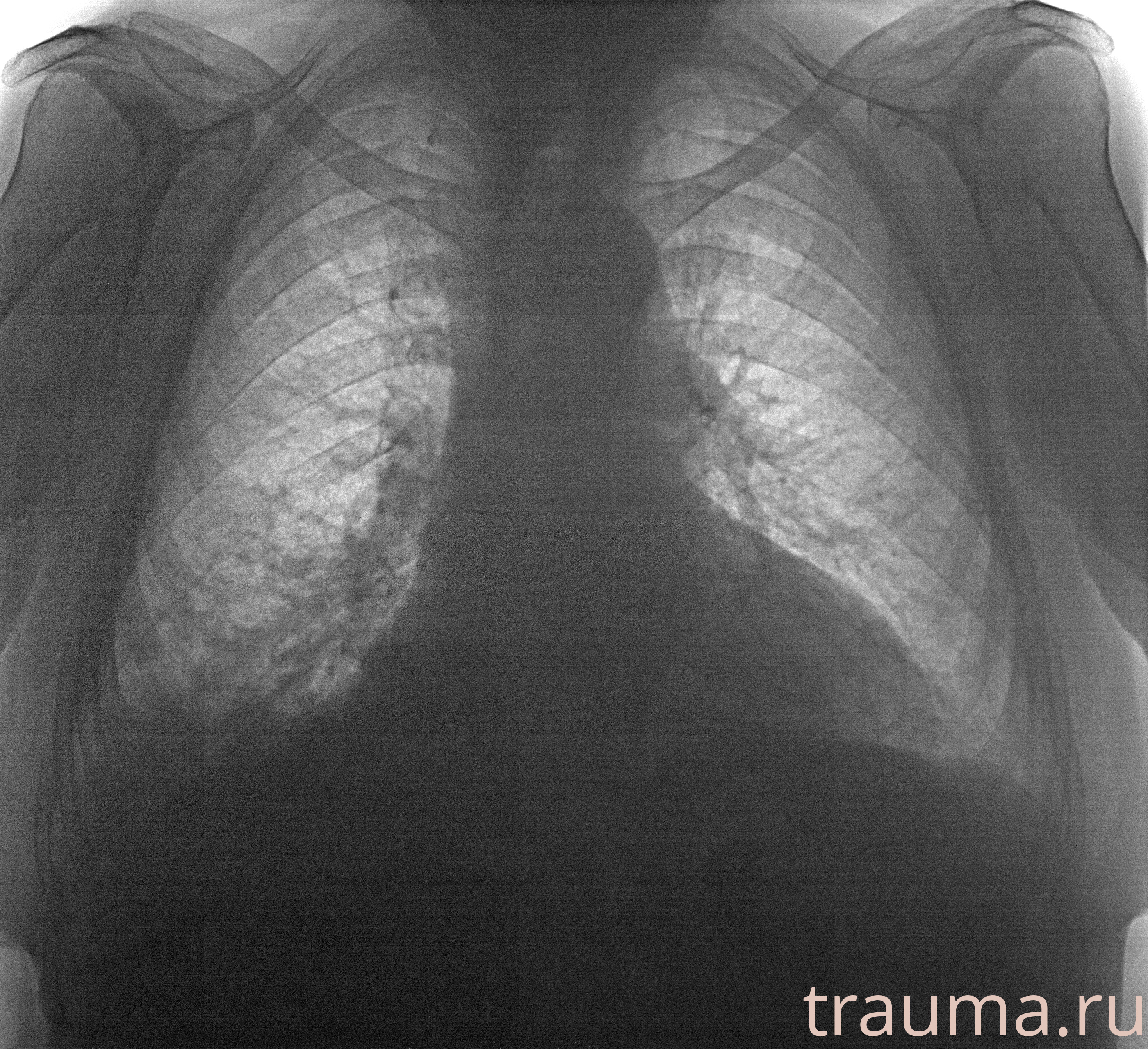 Рентген на дому: по вашему адресу приезжает врач-рентгенолог, травматолог-ортопед с мобильным рентгеновским аппаратом, проводит диагностику травмы или заболевания, делает необходимые рентгенограммы, дает рекомендации по дальнейшему лечению. Получить качественные снимки в домашних условиях возможно благодаря уникальной методике, разработанной МосРентген Центром для института  Склифосовского