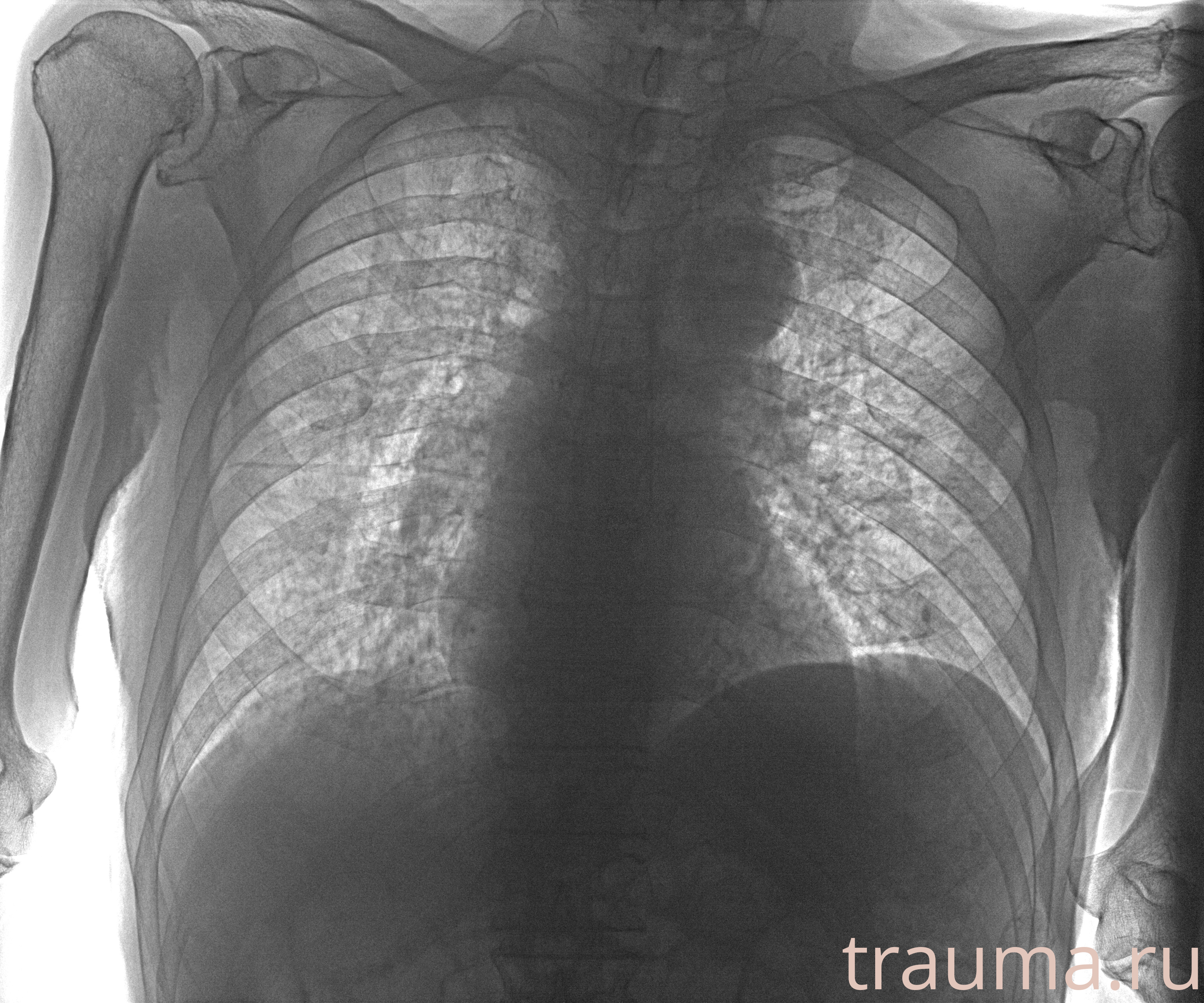 Рентген на дому: по вашему адресу приезжает врач-рентгенолог, травматолог-ортопед с мобильным рентгеновским аппаратом, проводит диагностику травмы или заболевания, делает необходимые рентгенограммы, дает рекомендации по дальнейшему лечению. Получить качественные снимки в домашних условиях возможно благодаря уникальной методике, разработанной МосРентген Центром для института  Склифосовского