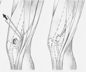 Минно-взрывная травма коленного сустава с повреждением подколенной артерии  