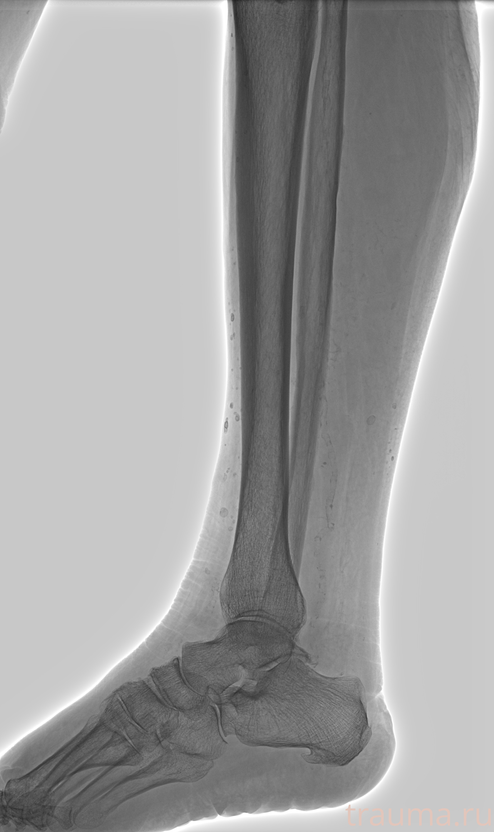 Рентген на дому: по вашему адресу приезжает врач-рентгенолог, травматолог-ортопед с мобильным рентгеновским аппаратом, проводит диагностику травмы или заболевания, делает необходимые рентгенограммы, дает рекомендации по дальнейшему лечению. Получить качественные снимки в домашних условиях возможно благодаря уникальной методике, разработанной МосРентген Центром для института  Склифосовского