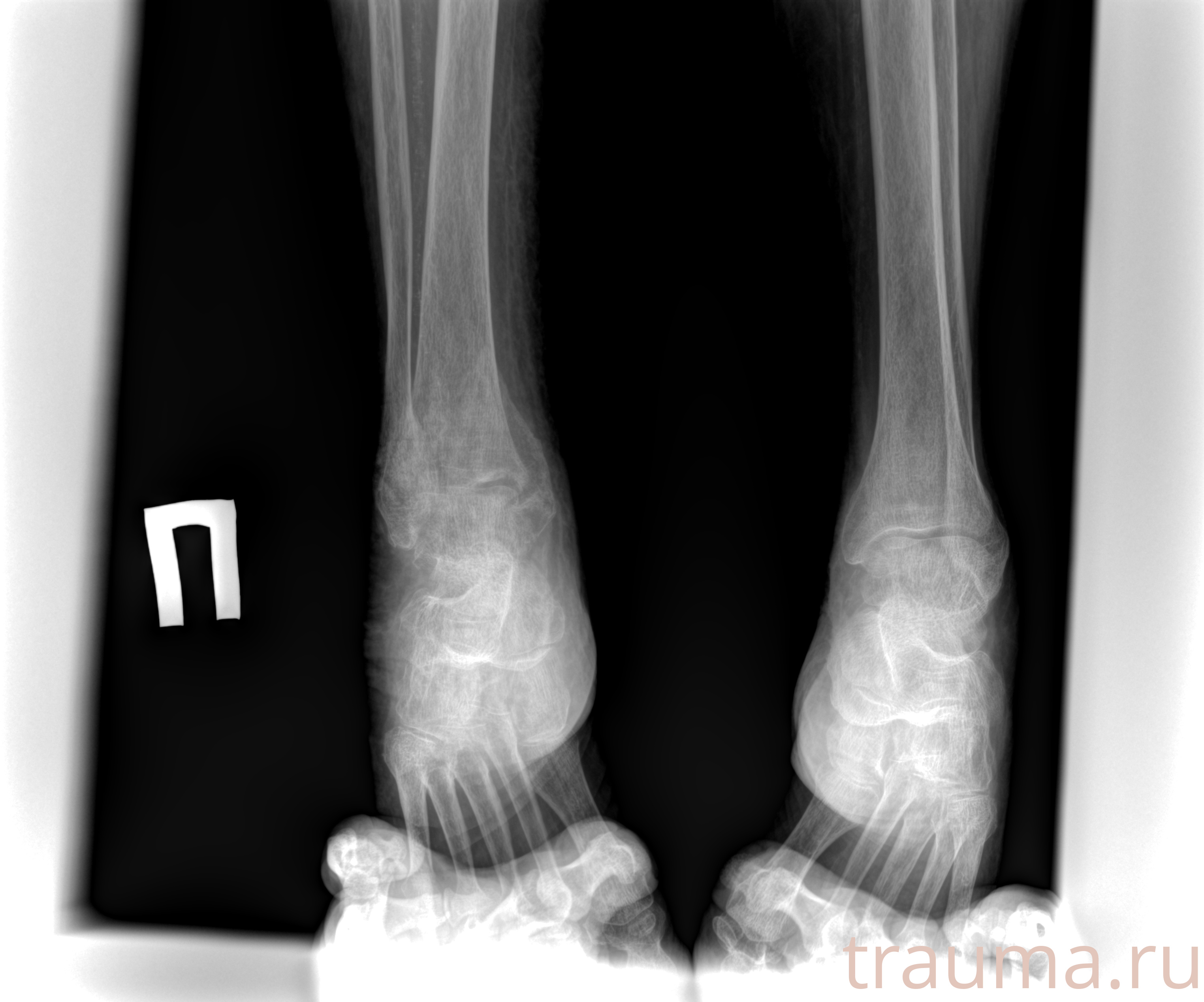 Рентген на дому: по вашему адресу приезжает врач-рентгенолог, травматолог-ортопед с мобильным рентгеновским аппаратом, проводит диагностику травмы или заболевания, делает необходимые рентгенограммы, дает рекомендации по дальнейшему лечению. Получить качественные снимки в домашних условиях возможно благодаря уникальной методике, разработанной МосРентген Центром для института  Склифосовского