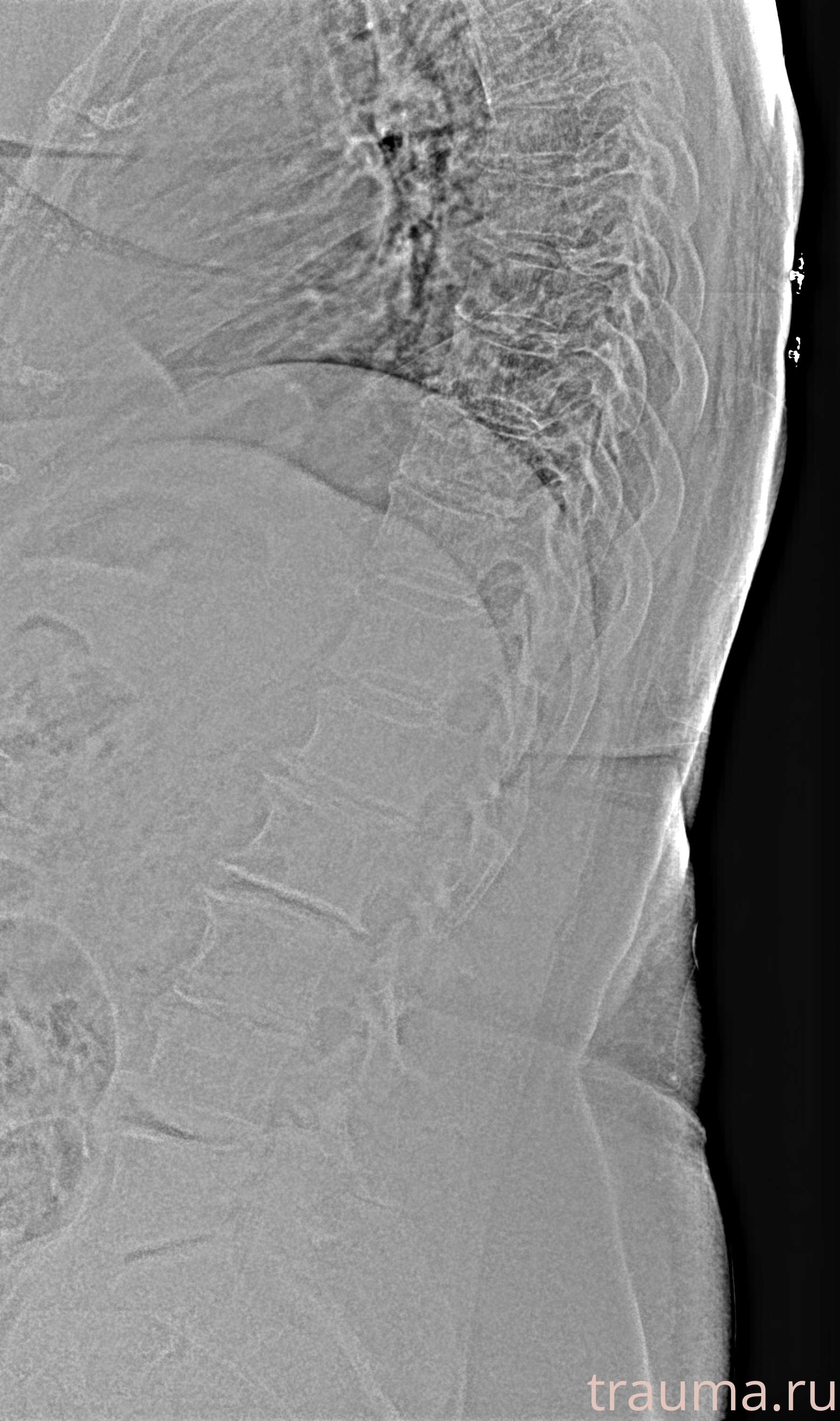 Рентген на дому: по вашему адресу приезжает врач-рентгенолог, травматолог-ортопед с мобильным рентгеновским аппаратом, проводит диагностику травмы или заболевания, делает необходимые рентгенограммы, дает рекомендации по дальнейшему лечению. Получить качественные снимки в домашних условиях возможно благодаря уникальной методике, разработанной МосРентген Центром для института  Склифосовского