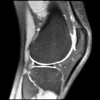 коленный сустав, повреждение сустава, МРТ