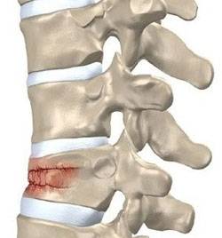 Осложненные переломы грудного и поясничного отделов позвоночника