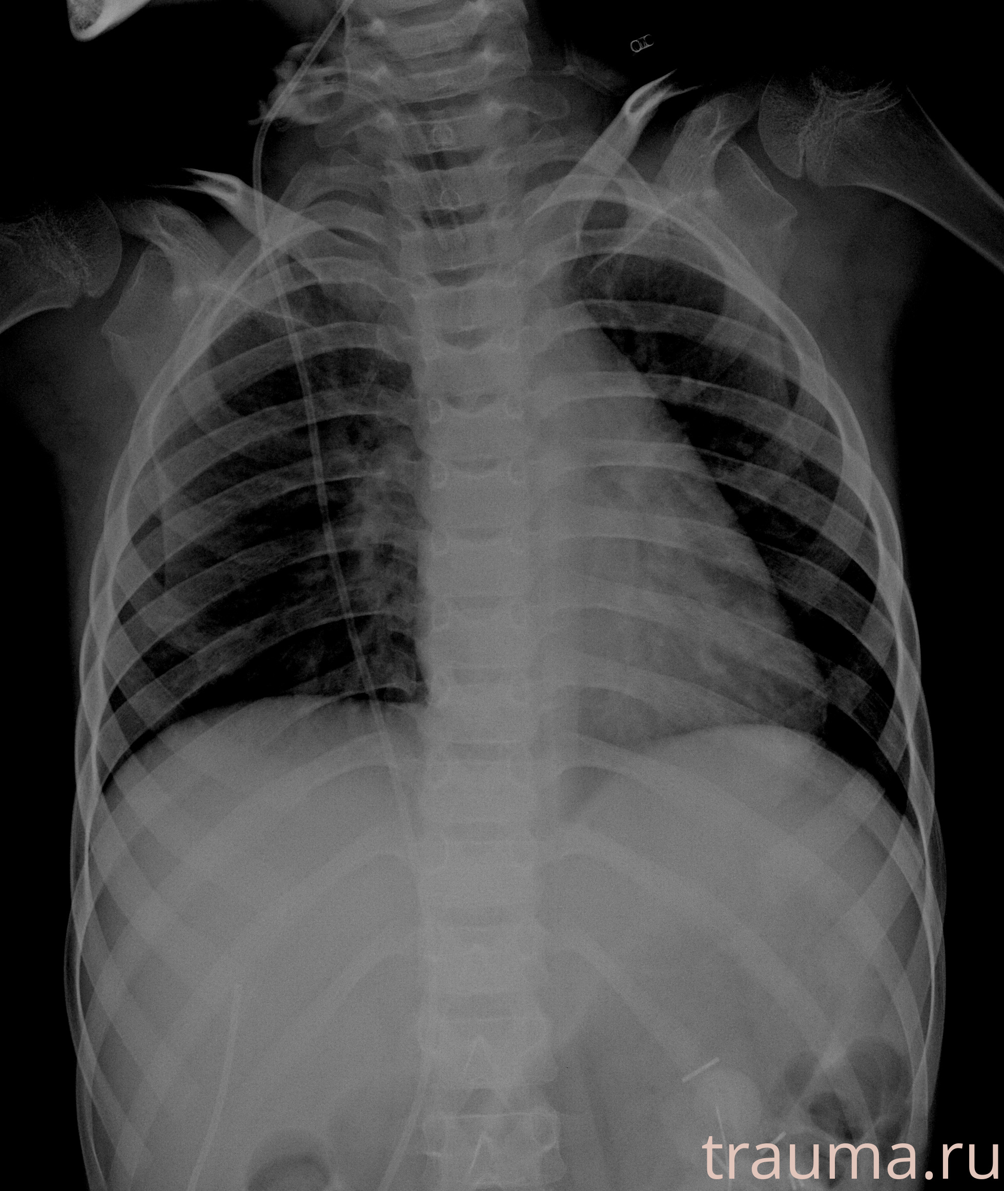 Рентген на дому: по вашему адресу приезжает врач-рентгенолог, травматолог-ортопед с мобильным рентгеновским аппаратом, проводит диагностику травмы или заболевания, делает необходимые рентгенограммы, дает рекомендации по дальнейшему лечению. Получить качественные снимки в домашних условиях возможно благодаря уникальной методике, разработанной МосРентген Центром для института  Склифосовского