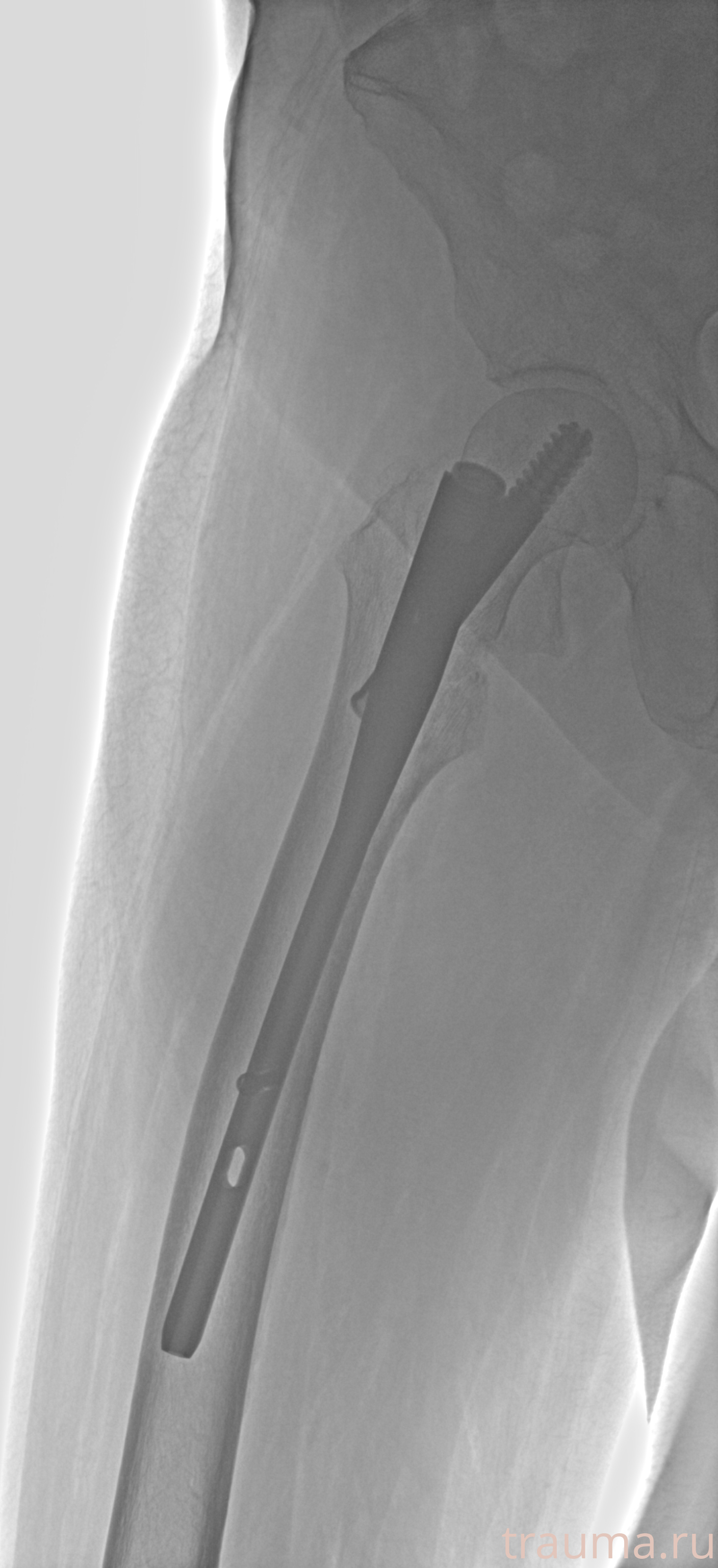 Рентген на дому: по вашему адресу приезжает врач-рентгенолог, травматолог-ортопед с мобильным рентгеновским аппаратом, проводит диагностику травмы или заболевания, делает необходимые рентгенограммы, дает рекомендации по дальнейшему лечению. Получить качественные снимки в домашних условиях возможно благодаря уникальной методике, разработанной МосРентген Центром для института  Склифосовского