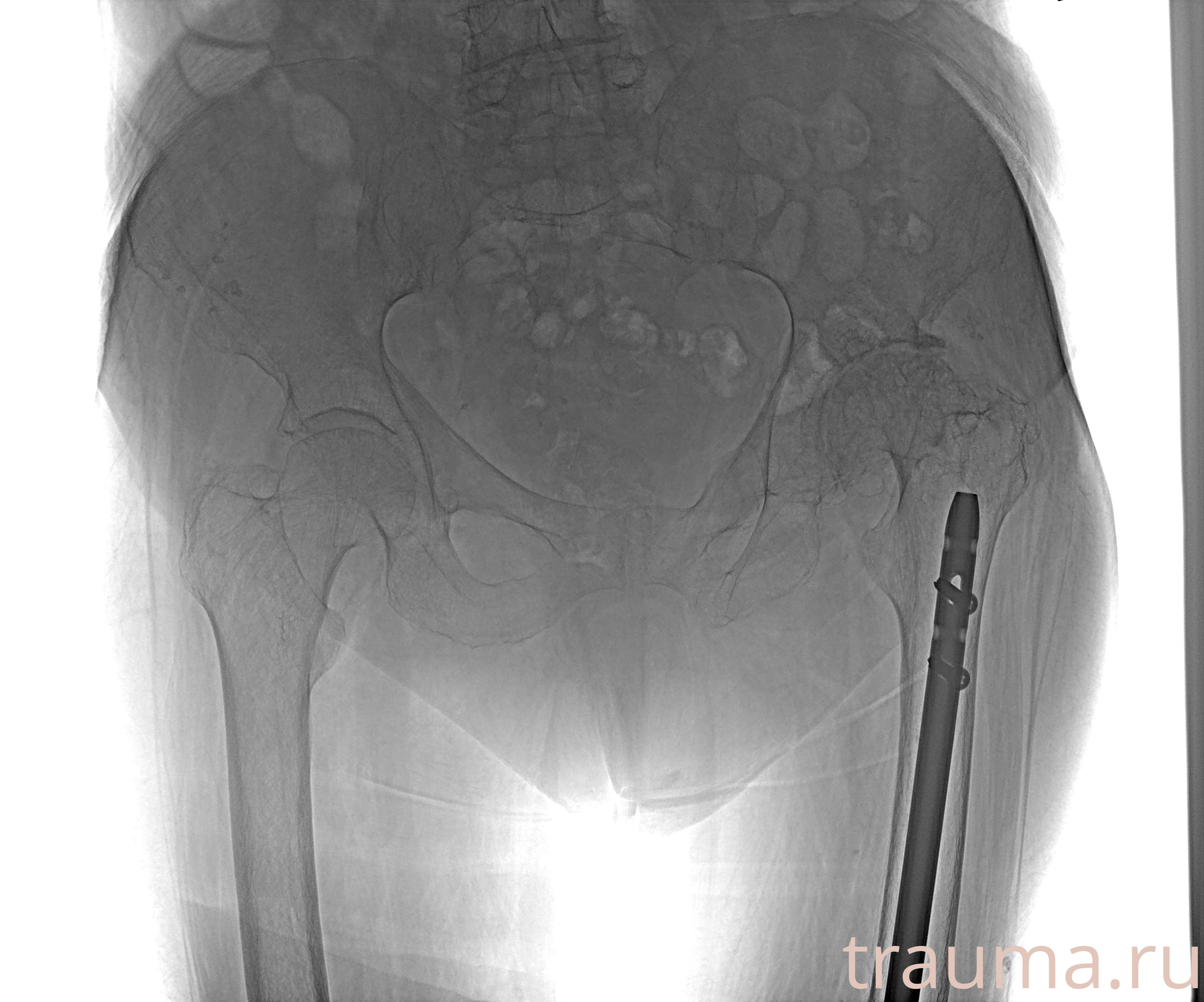 Рентген на дому: по вашему адресу приезжает врач-рентгенолог, травматолог-ортопед с мобильным рентгеновским аппаратом, проводит диагностику травмы или заболевания, делает необходимые рентгенограммы, дает рекомендации по дальнейшему лечению. Получить качественные снимки в домашних условиях возможно благодаря уникальной методике, разработанной МосРентген Центром для института  Склифосовского