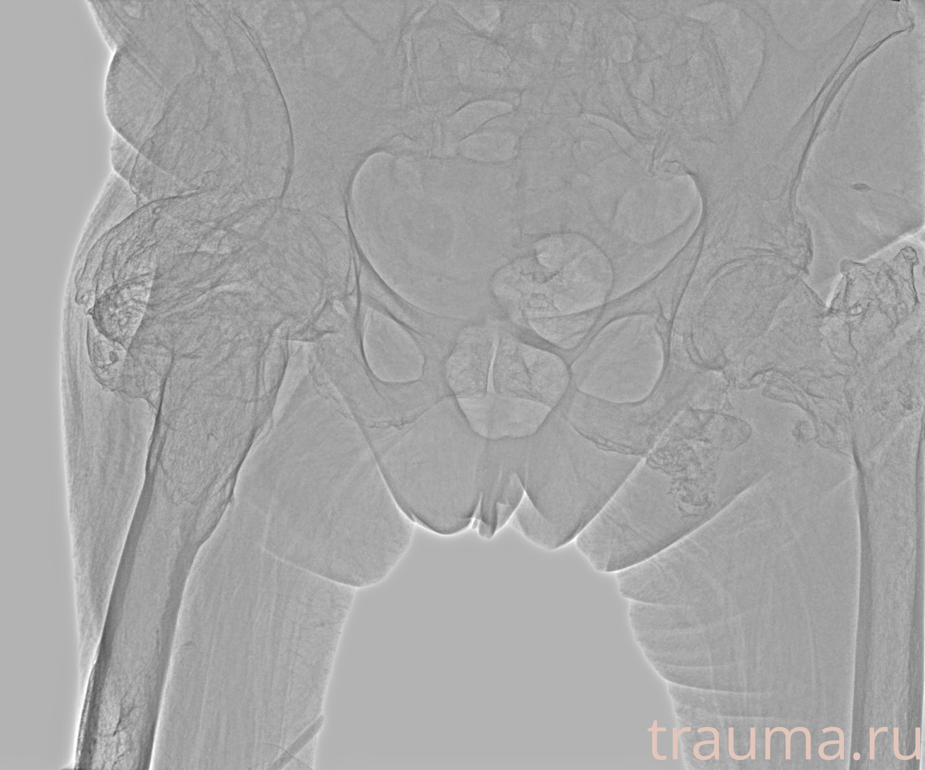 Рентген на дому: по вашему адресу приезжает врач-рентгенолог, травматолог-ортопед с мобильным рентгеновским аппаратом, проводит диагностику травмы или заболевания, делает необходимые рентгенограммы, дает рекомендации по дальнейшему лечению. Получить качественные снимки в домашних условиях возможно благодаря уникальной методике, разработанной МосРентген Центром для института  Склифосовского