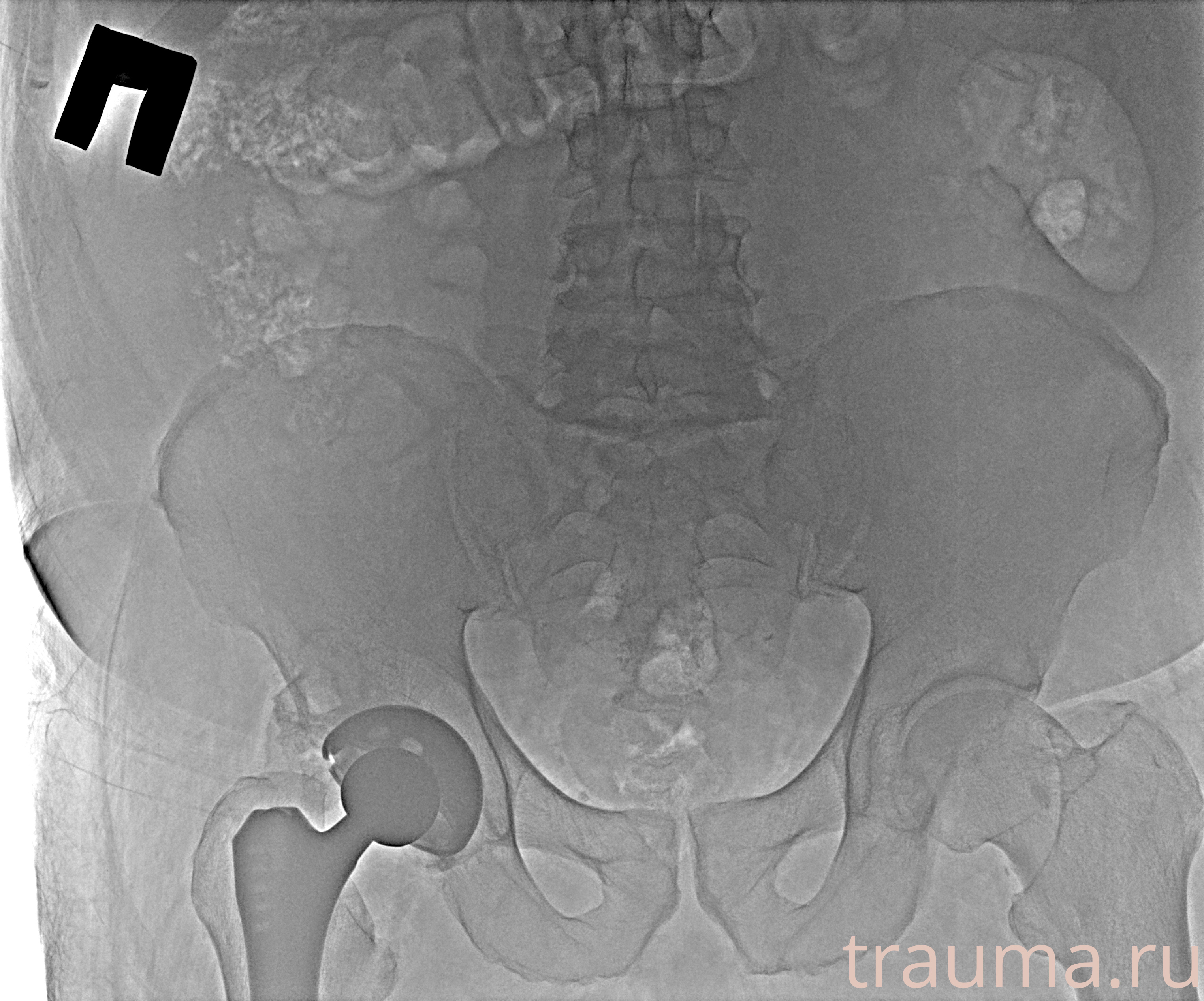 Рентген на дому: по вашему адресу приезжает врач-рентгенолог, травматолог-ортопед с мобильным рентгеновским аппаратом, проводит диагностику травмы или заболевания, делает необходимые рентгенограммы, дает рекомендации по дальнейшему лечению. Получить качественные снимки в домашних условиях возможно благодаря уникальной методике, разработанной МосРентген Центром для института  Склифосовского