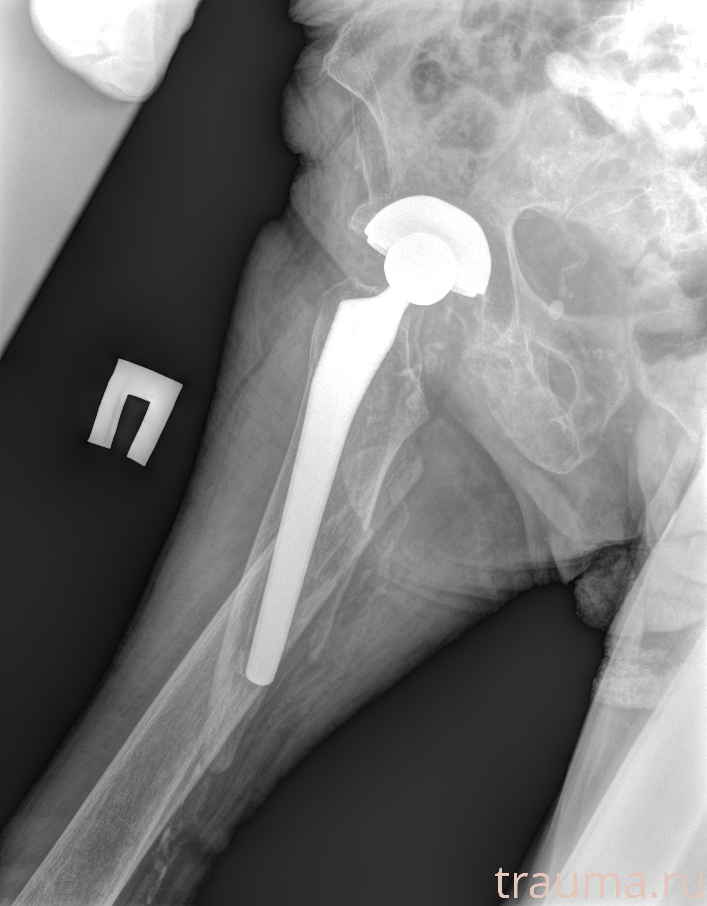 Рентген на дому: по вашему адресу приезжает врач-рентгенолог, травматолог-ортопед с мобильным рентгеновским аппаратом, проводит диагностику травмы или заболевания, делает необходимые рентгенограммы, дает рекомендации по дальнейшему лечению. Получить качественные снимки в домашних условиях возможно благодаря уникальной методике, разработанной МосРентген Центром для института  Склифосовского