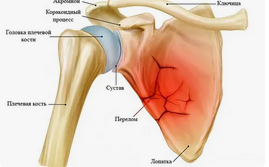 Перелом клювовидного отростка лопатки в сочетании с переломом акромиального конца ключицы: клинический случай