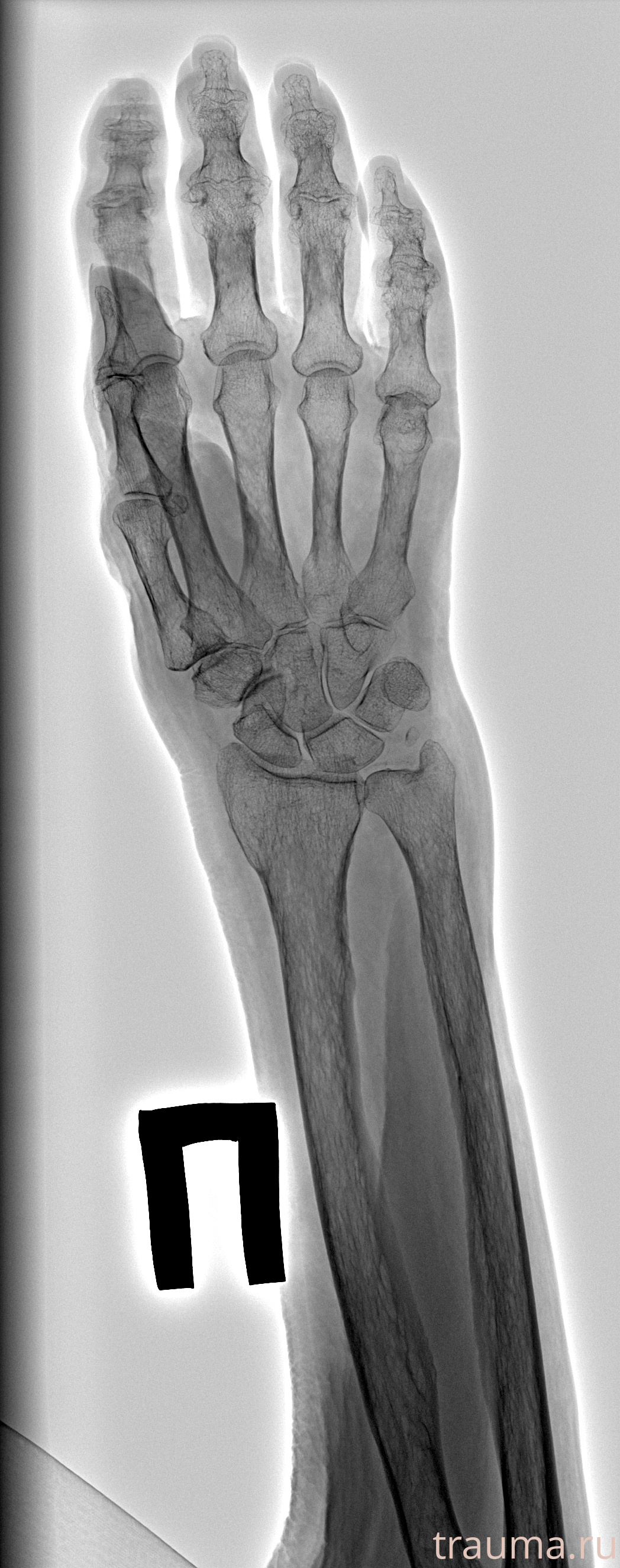 Рентген на дому: по вашему адресу приезжает врач-рентгенолог, травматолог-ортопед с мобильным рентгеновским аппаратом, проводит диагностику травмы или заболевания, делает необходимые рентгенограммы, дает рекомендации по дальнейшему лечению. Получить качественные снимки в домашних условиях возможно благодаря уникальной методике, разработанной МосРентген Центром для института  Склифосовского