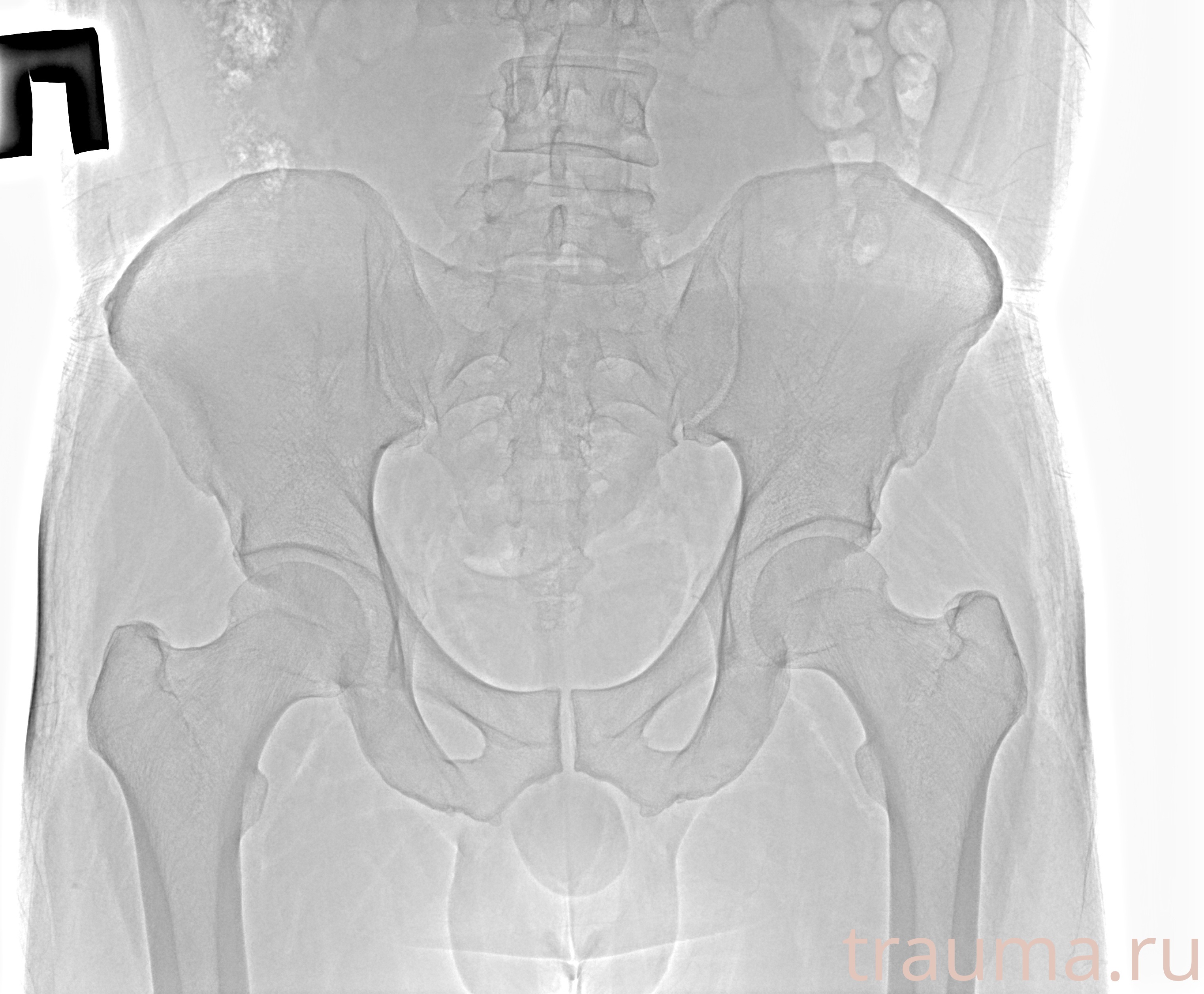 Рентген на дому: по вашему адресу приезжает врач-рентгенолог, травматолог-ортопед с мобильным рентгеновским аппаратом, проводит диагностику травмы или заболевания, делает необходимые рентгенограммы, дает рекомендации по дальнейшему лечению. Получить качественные снимки в домашних условиях возможно благодаря уникальной методике, разработанной МосРентген Центром для института  Склифосовского