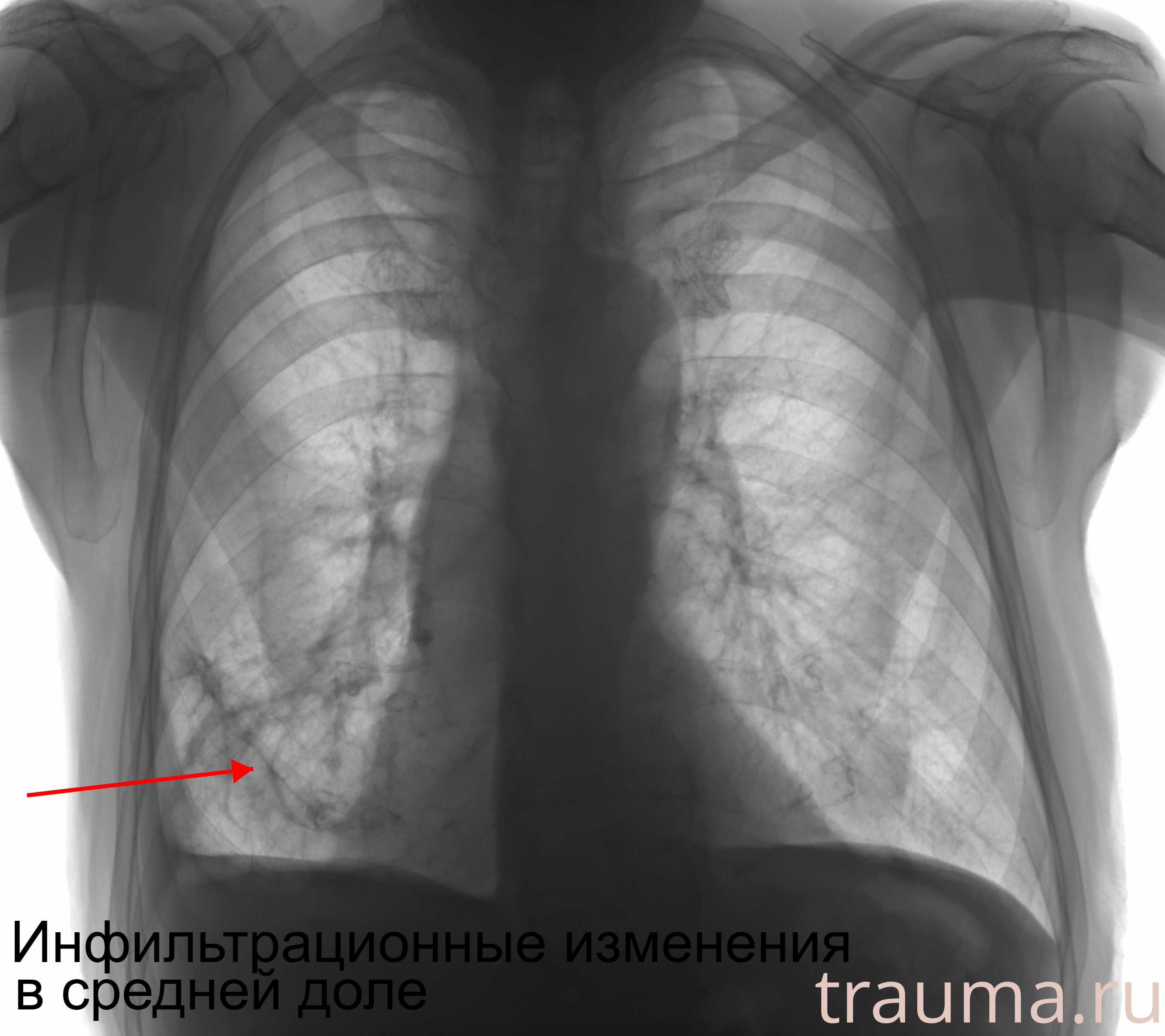 Рентген на дому: по вашему адресу приезжает врач-рентгенолог, травматолог-ортопед с мобильным рентгеновским аппаратом, проводит диагностику травмы или заболевания, делает необходимые рентгенограммы, дает рекомендации по дальнейшему лечению. Получить качественные снимки в домашних условиях возможно благодаря уникальной методике, разработанной МосРентген Центром для института  Склифосовского
