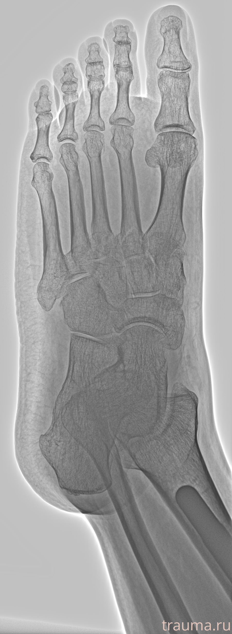 Рентген на дому: по вашему адресу приезжает врач-рентгенолог, травматолог-ортопед с мобильным рентгеновским аппаратом, проводит диагностику травмы или заболевания, делает необходимые рентгенограммы, дает рекомендации по дальнейшему лечению. Получить качественные снимки в домашних условиях возможно благодаря уникальной методике, разработанной МосРентген Центром для института  Склифосовского