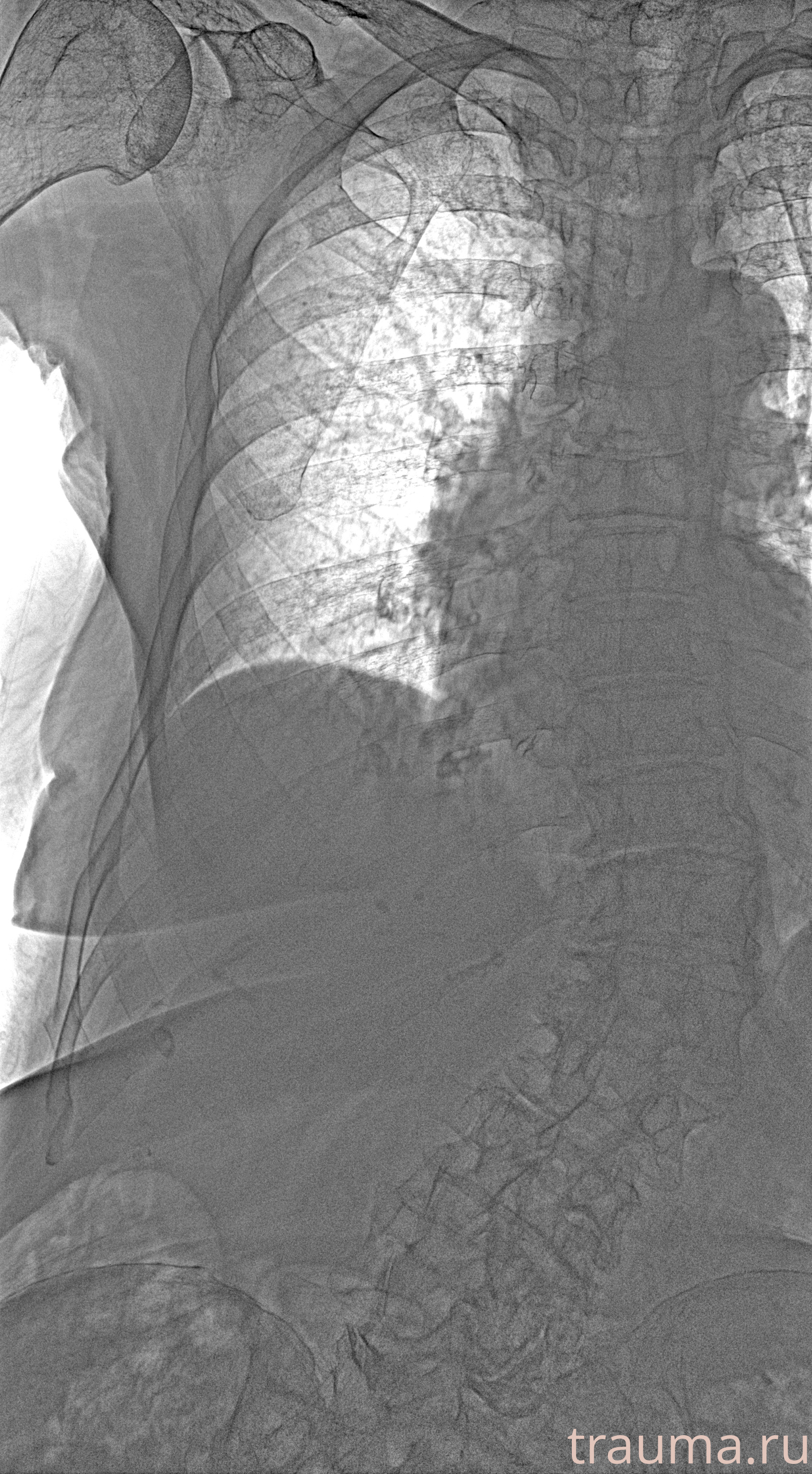 Рентген на дому: по вашему адресу приезжает врач-рентгенолог, травматолог-ортопед с мобильным рентгеновским аппаратом, проводит диагностику травмы или заболевания, делает необходимые рентгенограммы, дает рекомендации по дальнейшему лечению. Получить качественные снимки в домашних условиях возможно благодаря уникальной методике, разработанной МосРентген Центром для института  Склифосовского