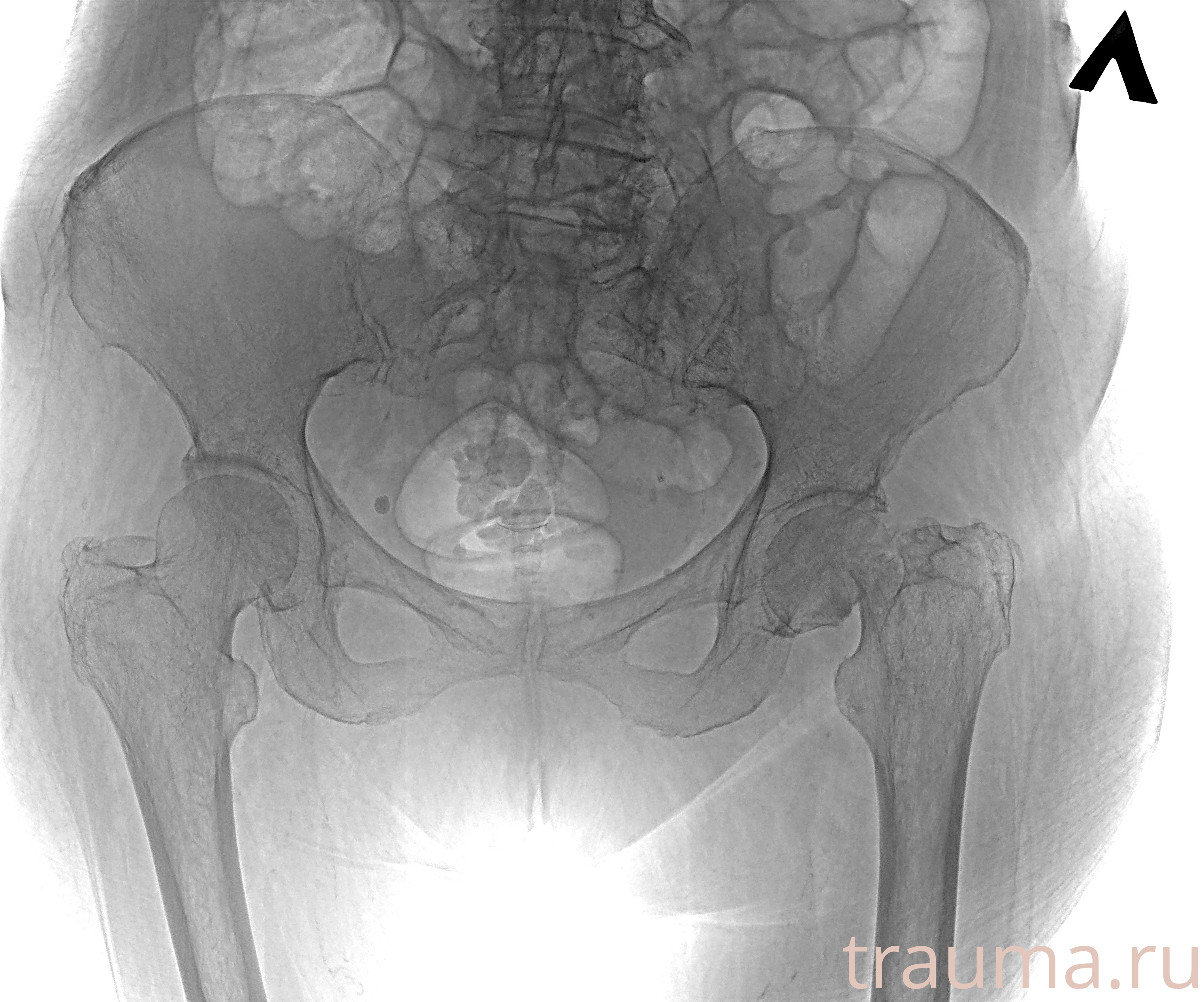Рентген на дому: по вашему адресу приезжает врач-рентгенолог, травматолог-ортопед с мобильным рентгеновским аппаратом, проводит диагностику травмы или заболевания, делает необходимые рентгенограммы, дает рекомендации по дальнейшему лечению. Получить качественные снимки в домашних условиях возможно благодаря уникальной методике, разработанной МосРентген Центром для института  Склифосовского