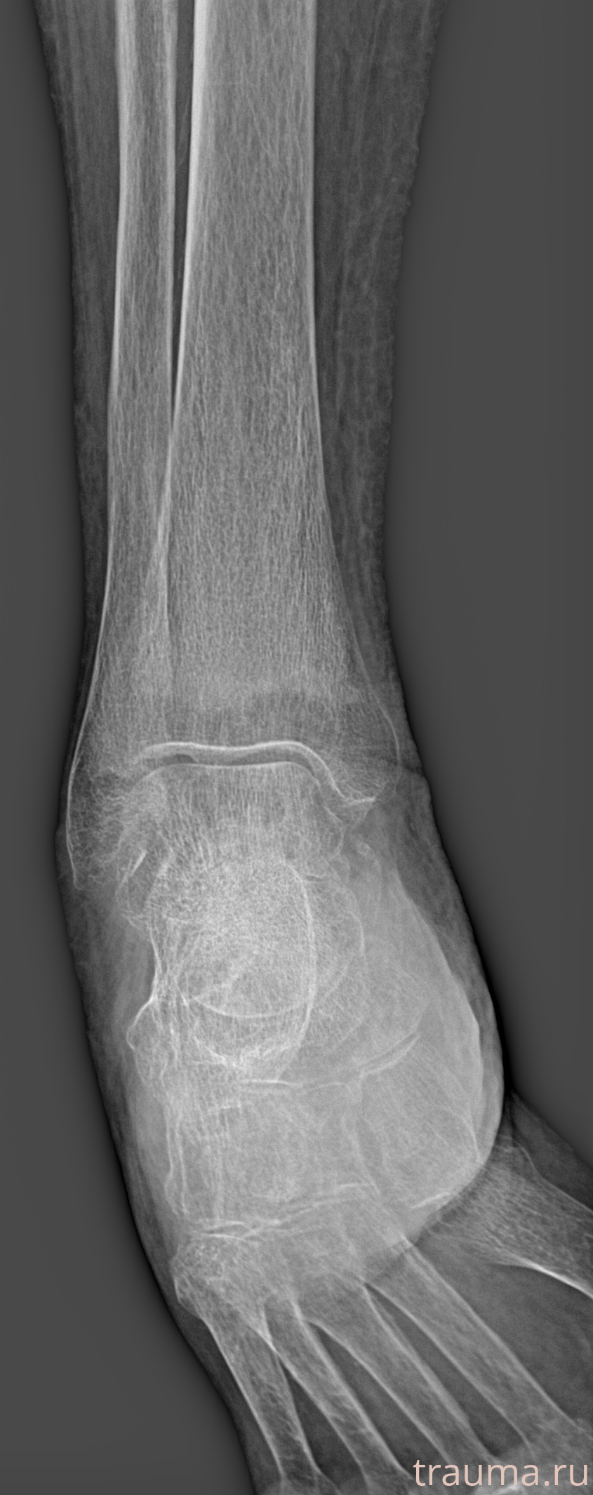 Рентген на дому: по вашему адресу приезжает врач-рентгенолог, травматолог-ортопед с мобильным рентгеновским аппаратом, проводит диагностику травмы или заболевания, делает необходимые рентгенограммы, дает рекомендации по дальнейшему лечению. Получить качественные снимки в домашних условиях возможно благодаря уникальной методике, разработанной МосРентген Центром для института  Склифосовского