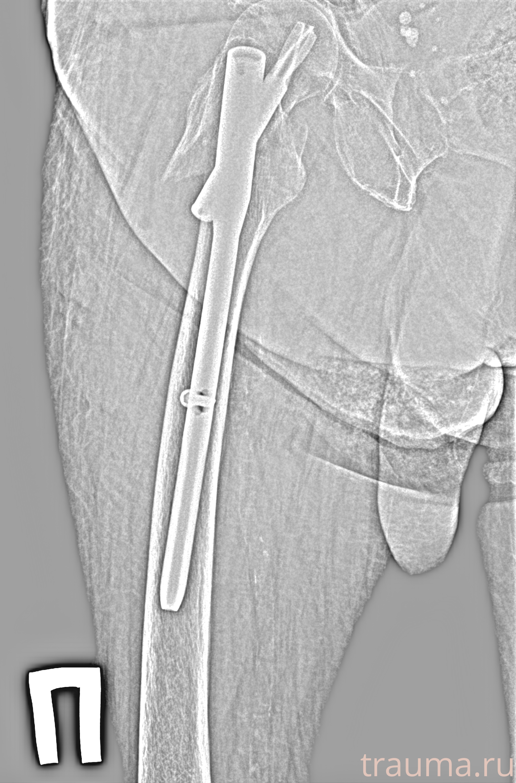 Рентген на дому: по вашему адресу приезжает врач-рентгенолог, травматолог-ортопед с мобильным рентгеновским аппаратом, проводит диагностику травмы или заболевания, делает необходимые рентгенограммы, дает рекомендации по дальнейшему лечению. Получить качественные снимки в домашних условиях возможно благодаря уникальной методике, разработанной МосРентген Центром для института  Склифосовского