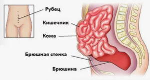 Послеоперационная вентральная грыжа