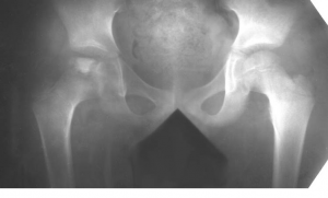Роль рентгенографии и магнитно-резонансной томографии в диагностике юношеского эпифизеолиза головки бедренной кости у детей и подростков