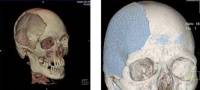 свод черепа,  трепанация черепа,  хирургические вмешательства