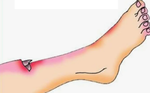 Современные представления о патогенезе и лечении инфекционных осложнений при открытых переломах голени