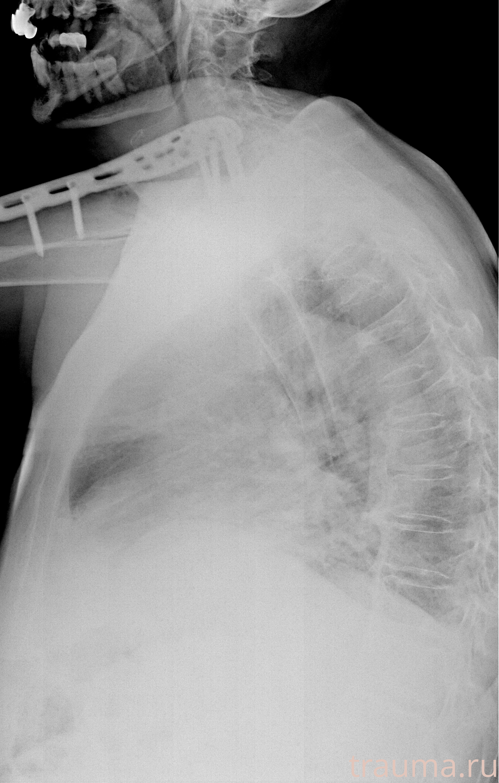 Рентген на дому: по вашему адресу приезжает врач-рентгенолог, травматолог-ортопед с мобильным рентгеновским аппаратом, проводит диагностику травмы или заболевания, делает необходимые рентгенограммы, дает рекомендации по дальнейшему лечению. Получить качественные снимки в домашних условиях возможно благодаря уникальной методике, разработанной МосРентген Центром для института  Склифосовского