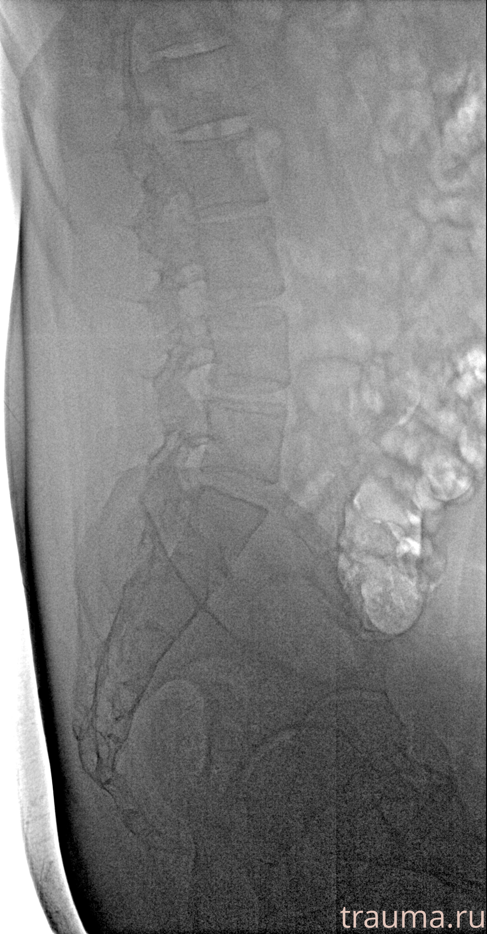 Рентген на дому: по вашему адресу приезжает врач-рентгенолог, травматолог-ортопед с мобильным рентгеновским аппаратом, проводит диагностику травмы или заболевания, делает необходимые рентгенограммы, дает рекомендации по дальнейшему лечению. Получить качественные снимки в домашних условиях возможно благодаря уникальной методике, разработанной МосРентген Центром для института  Склифосовского