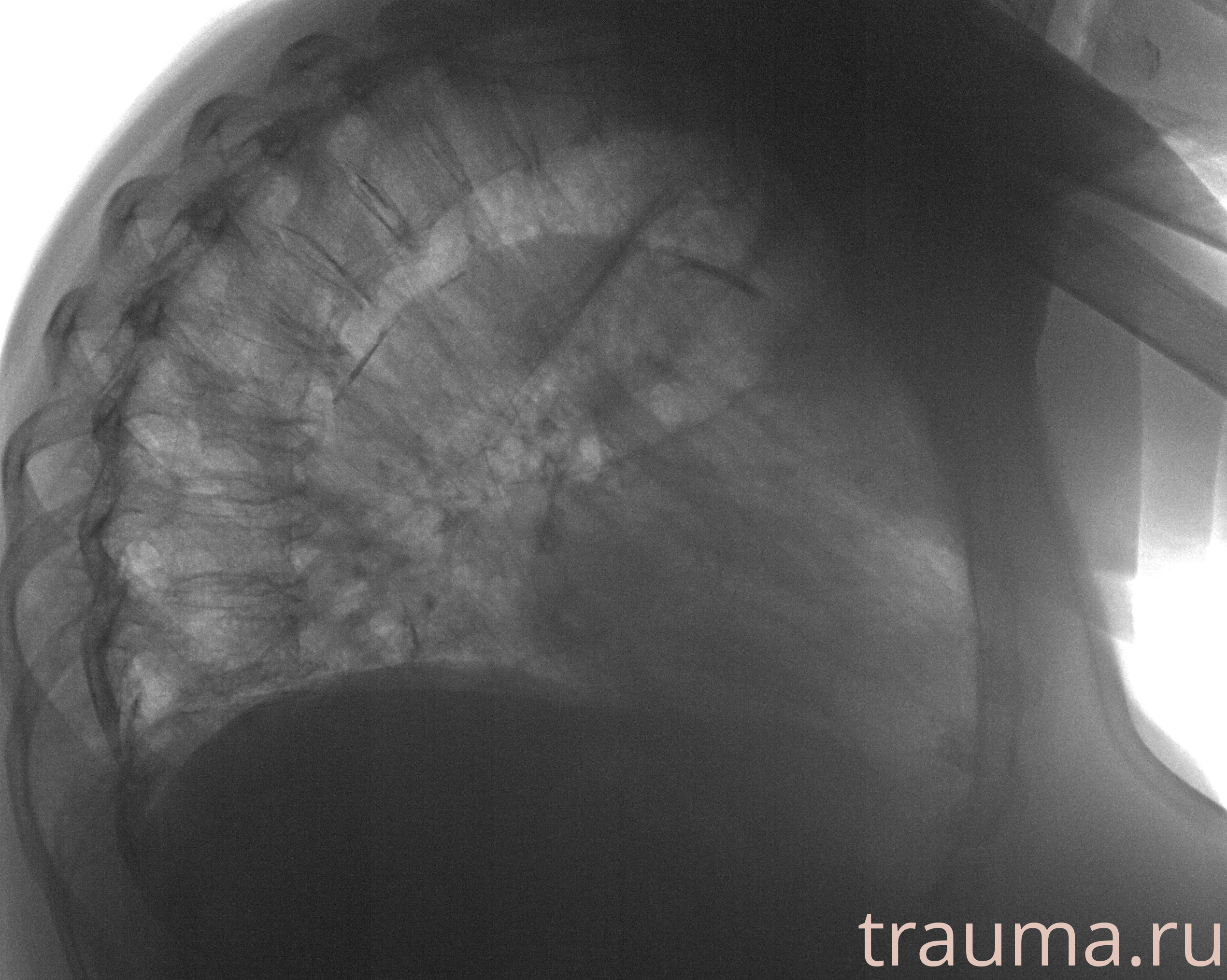 Рентген на дому: по вашему адресу приезжает врач-рентгенолог, травматолог-ортопед с мобильным рентгеновским аппаратом, проводит диагностику травмы или заболевания, делает необходимые рентгенограммы, дает рекомендации по дальнейшему лечению. Получить качественные снимки в домашних условиях возможно благодаря уникальной методике, разработанной МосРентген Центром для института  Склифосовского