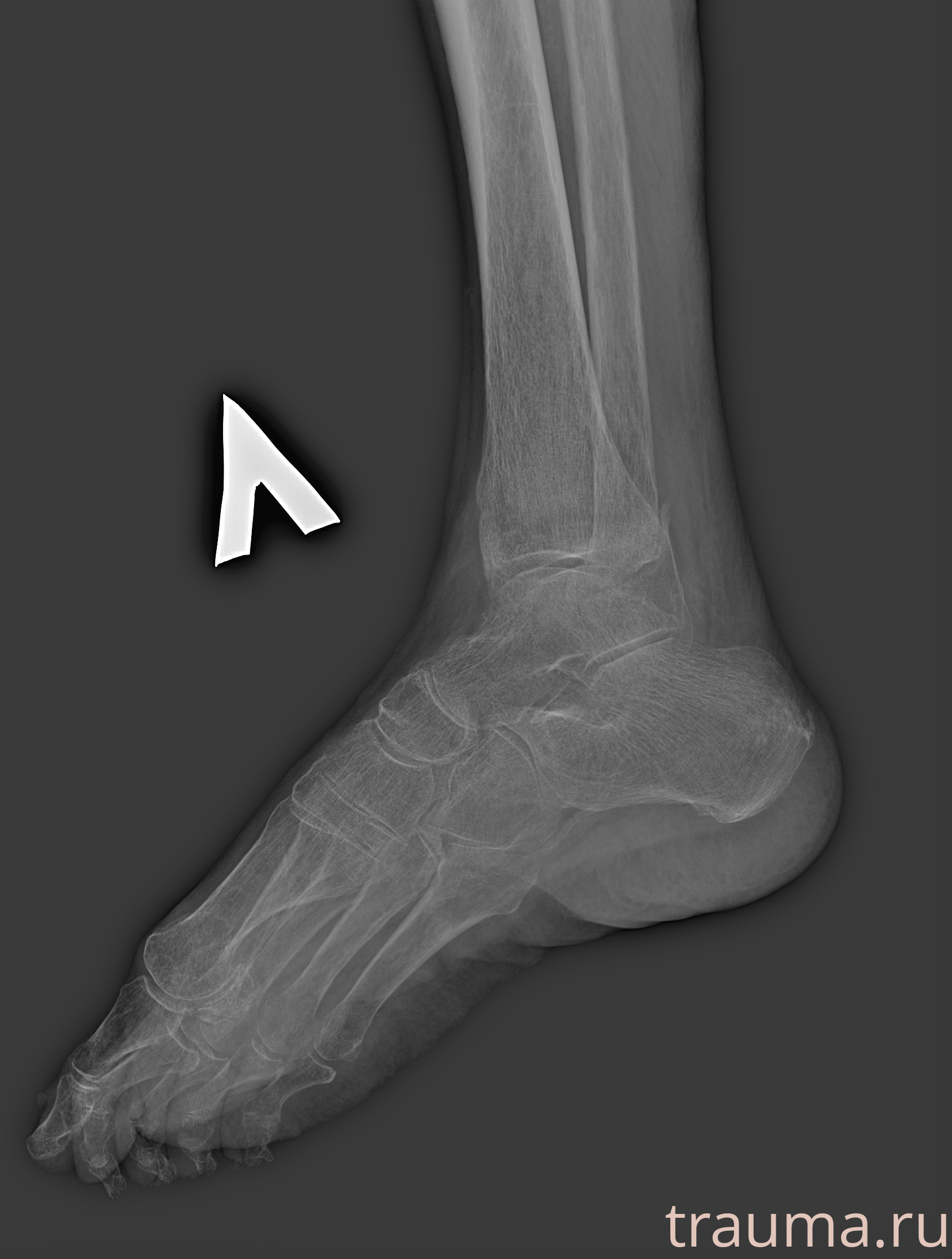 Рентген на дому: по вашему адресу приезжает врач-рентгенолог, травматолог-ортопед с мобильным рентгеновским аппаратом, проводит диагностику травмы или заболевания, делает необходимые рентгенограммы, дает рекомендации по дальнейшему лечению. Получить качественные снимки в домашних условиях возможно благодаря уникальной методике, разработанной МосРентген Центром для института  Склифосовского
