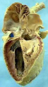Курс медицинской рентгенологии.Рентгенологическое исследование органов кровообращения(сердца и больших сосудов).Часть 2. Глава 8.4