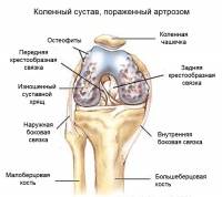 Оперативное лечение гетерогенного деформирующего артроза коленного сустава