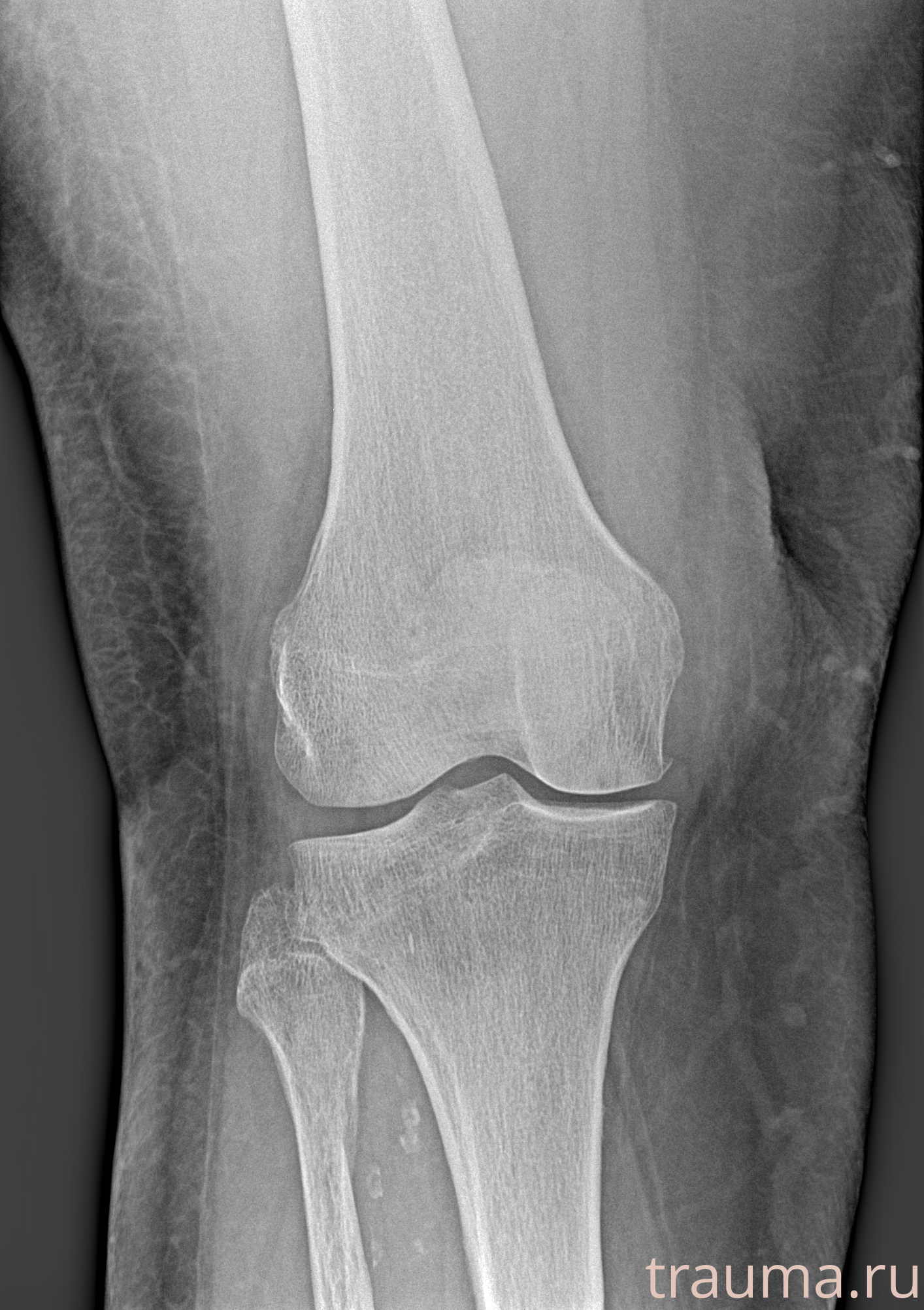Рентген на дому: по вашему адресу приезжает врач-рентгенолог, травматолог-ортопед с мобильным рентгеновским аппаратом, проводит диагностику травмы или заболевания, делает необходимые рентгенограммы, дает рекомендации по дальнейшему лечению. Получить качественные снимки в домашних условиях возможно благодаря уникальной методике, разработанной МосРентген Центром для института  Склифосовского