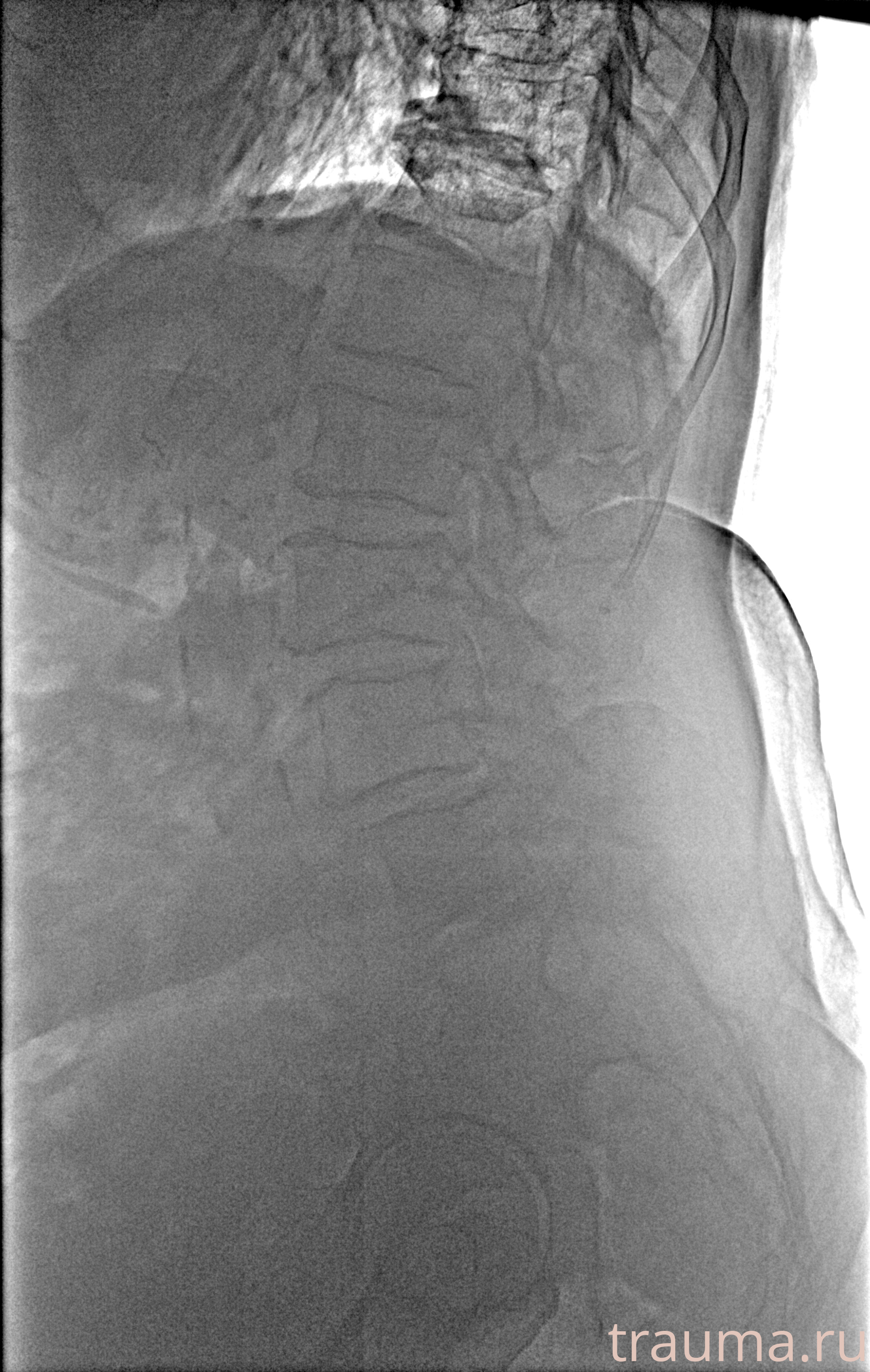 Рентген на дому: по вашему адресу приезжает врач-рентгенолог, травматолог-ортопед с мобильным рентгеновским аппаратом, проводит диагностику травмы или заболевания, делает необходимые рентгенограммы, дает рекомендации по дальнейшему лечению. Получить качественные снимки в домашних условиях возможно благодаря уникальной методике, разработанной МосРентген Центром для института  Склифосовского