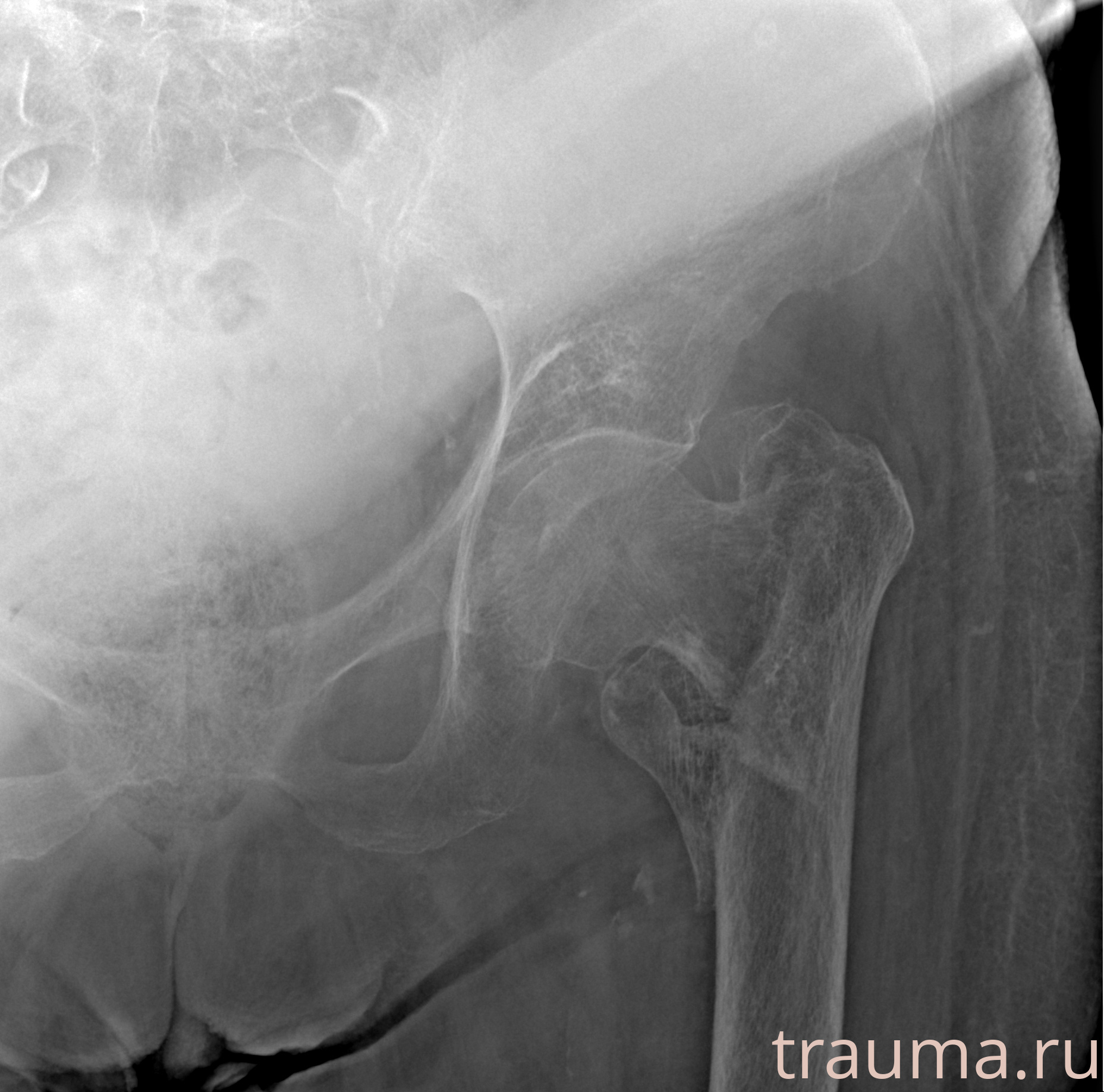 Рентген на дому: по вашему адресу приезжает врач-рентгенолог, травматолог-ортопед с мобильным рентгеновским аппаратом, проводит диагностику травмы или заболевания, делает необходимые рентгенограммы, дает рекомендации по дальнейшему лечению. Получить качественные снимки в домашних условиях возможно благодаря уникальной методике, разработанной МосРентген Центром для института  Склифосовского