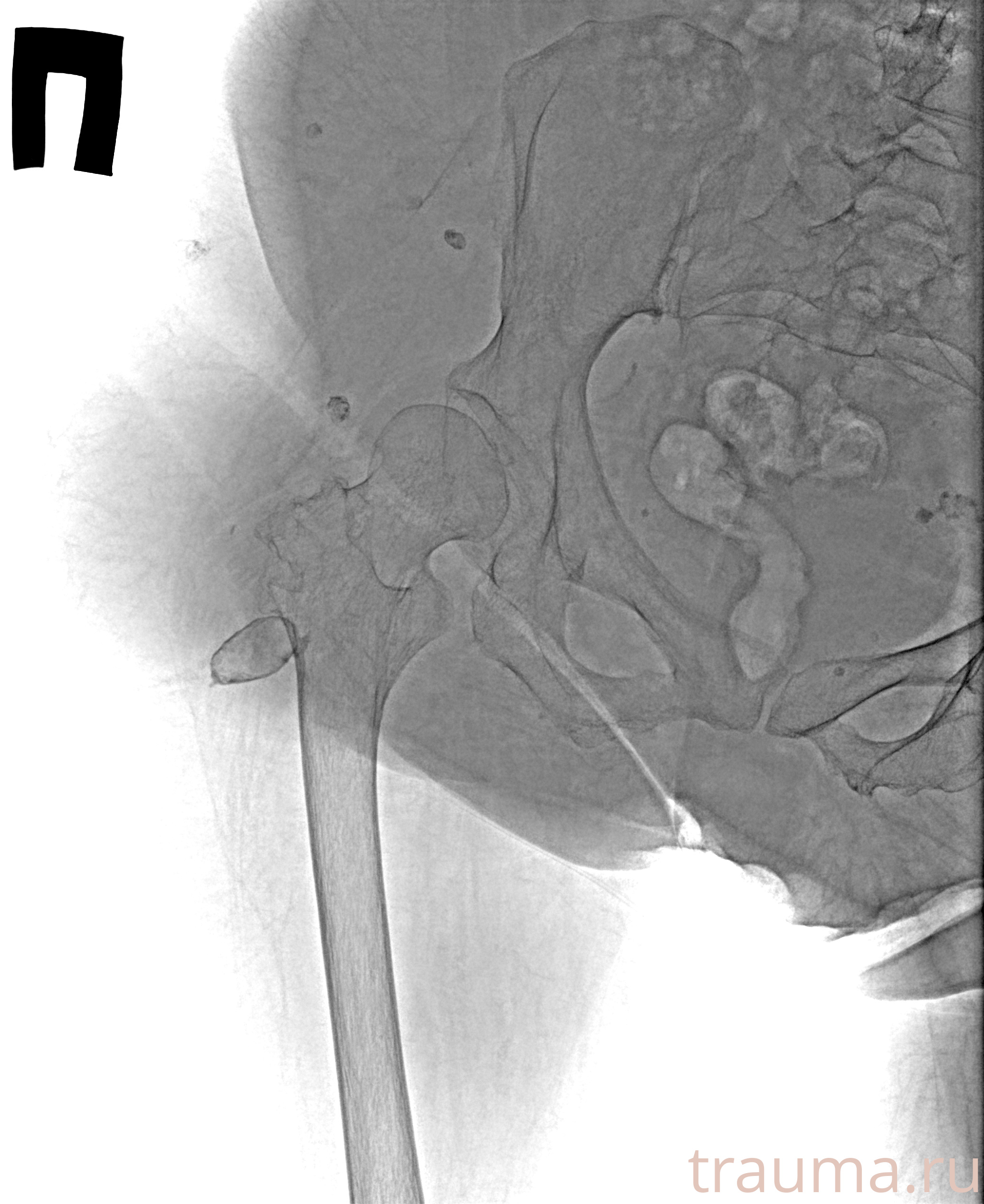 Рентген на дому: по вашему адресу приезжает врач-рентгенолог, травматолог-ортопед с мобильным рентгеновским аппаратом, проводит диагностику травмы или заболевания, делает необходимые рентгенограммы, дает рекомендации по дальнейшему лечению. Получить качественные снимки в домашних условиях возможно благодаря уникальной методике, разработанной МосРентген Центром для института  Склифосовского