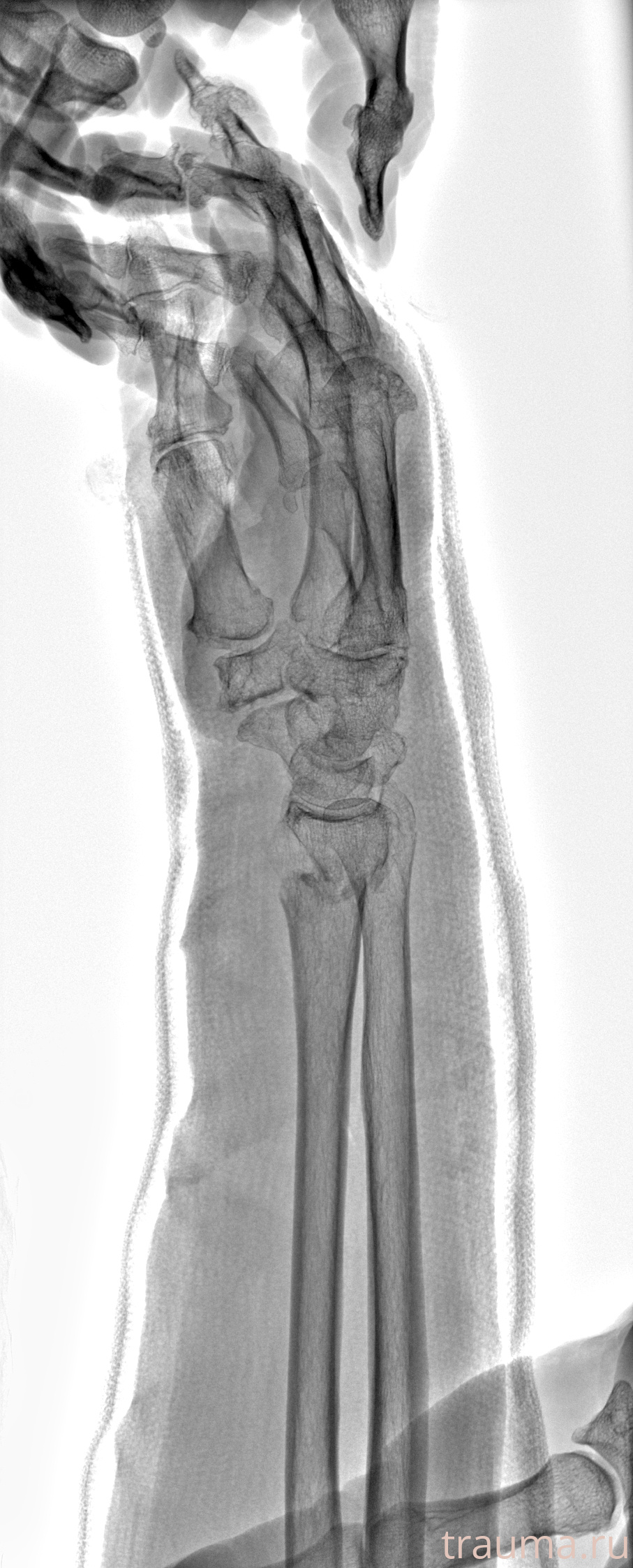 Рентген на дому: по вашему адресу приезжает врач-рентгенолог, травматолог-ортопед с мобильным рентгеновским аппаратом, проводит диагностику травмы или заболевания, делает необходимые рентгенограммы, дает рекомендации по дальнейшему лечению. Получить качественные снимки в домашних условиях возможно благодаря уникальной методике, разработанной МосРентген Центром для института  Склифосовского