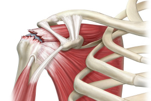 Застарелое повреждение мышц надплечья и вращательной манжеты плеча: клинический кейс миофасциальной транспозиции