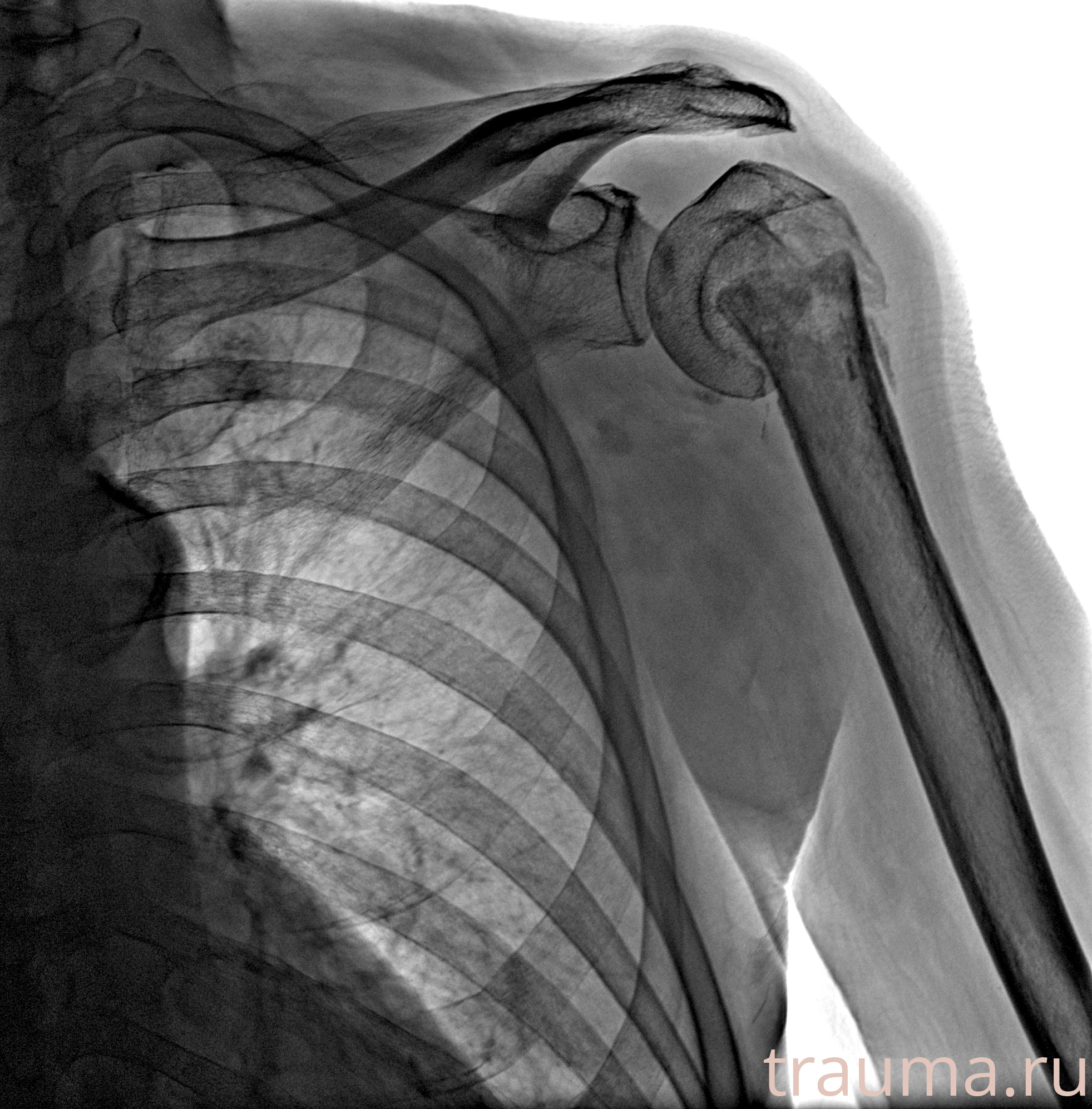 Рентген на дому: по вашему адресу приезжает врач-рентгенолог, травматолог-ортопед с мобильным рентгеновским аппаратом, проводит диагностику травмы или заболевания, делает необходимые рентгенограммы, дает рекомендации по дальнейшему лечению. Получить качественные снимки в домашних условиях возможно благодаря уникальной методике, разработанной МосРентген Центром для института  Склифосовского