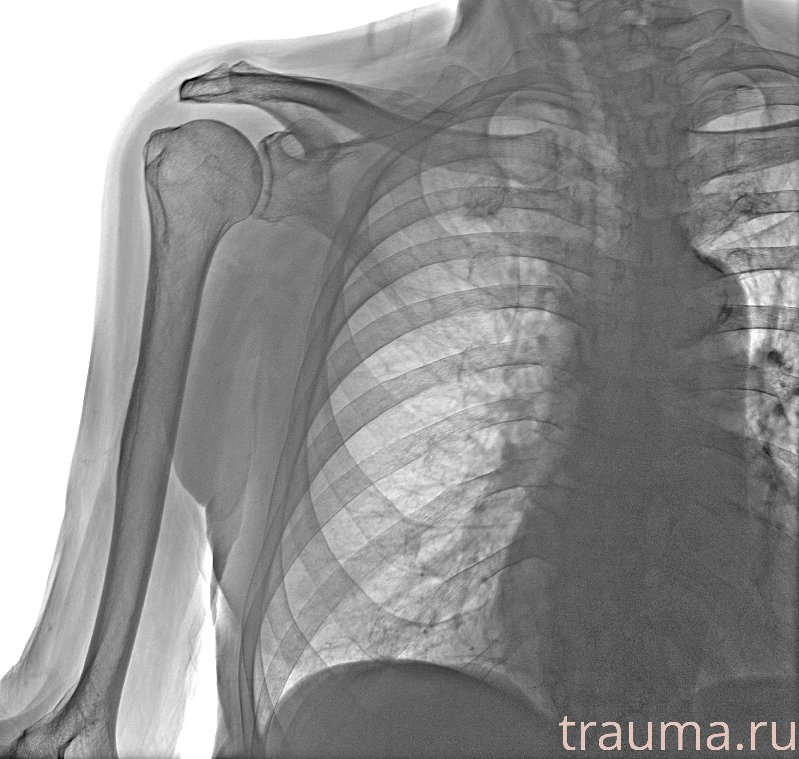 Рентген на дому: по вашему адресу приезжает врач-рентгенолог, травматолог-ортопед с мобильным рентгеновским аппаратом, проводит диагностику травмы или заболевания, делает необходимые рентгенограммы, дает рекомендации по дальнейшему лечению. Получить качественные снимки в домашних условиях возможно благодаря уникальной методике, разработанной МосРентген Центром для института  Склифосовского