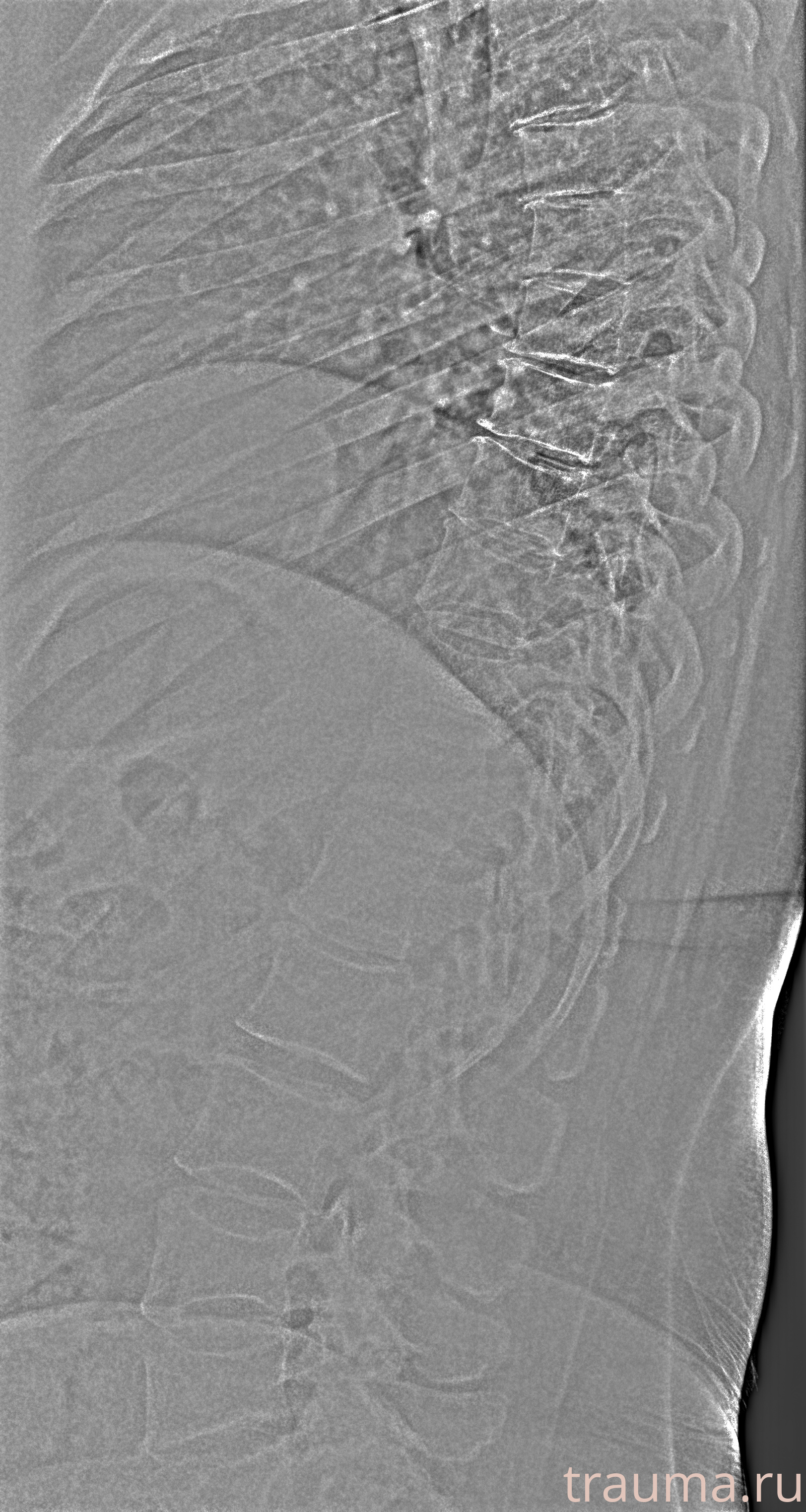 Рентген на дому: по вашему адресу приезжает врач-рентгенолог, травматолог-ортопед с мобильным рентгеновским аппаратом, проводит диагностику травмы или заболевания, делает необходимые рентгенограммы, дает рекомендации по дальнейшему лечению. Получить качественные снимки в домашних условиях возможно благодаря уникальной методике, разработанной МосРентген Центром для института  Склифосовского