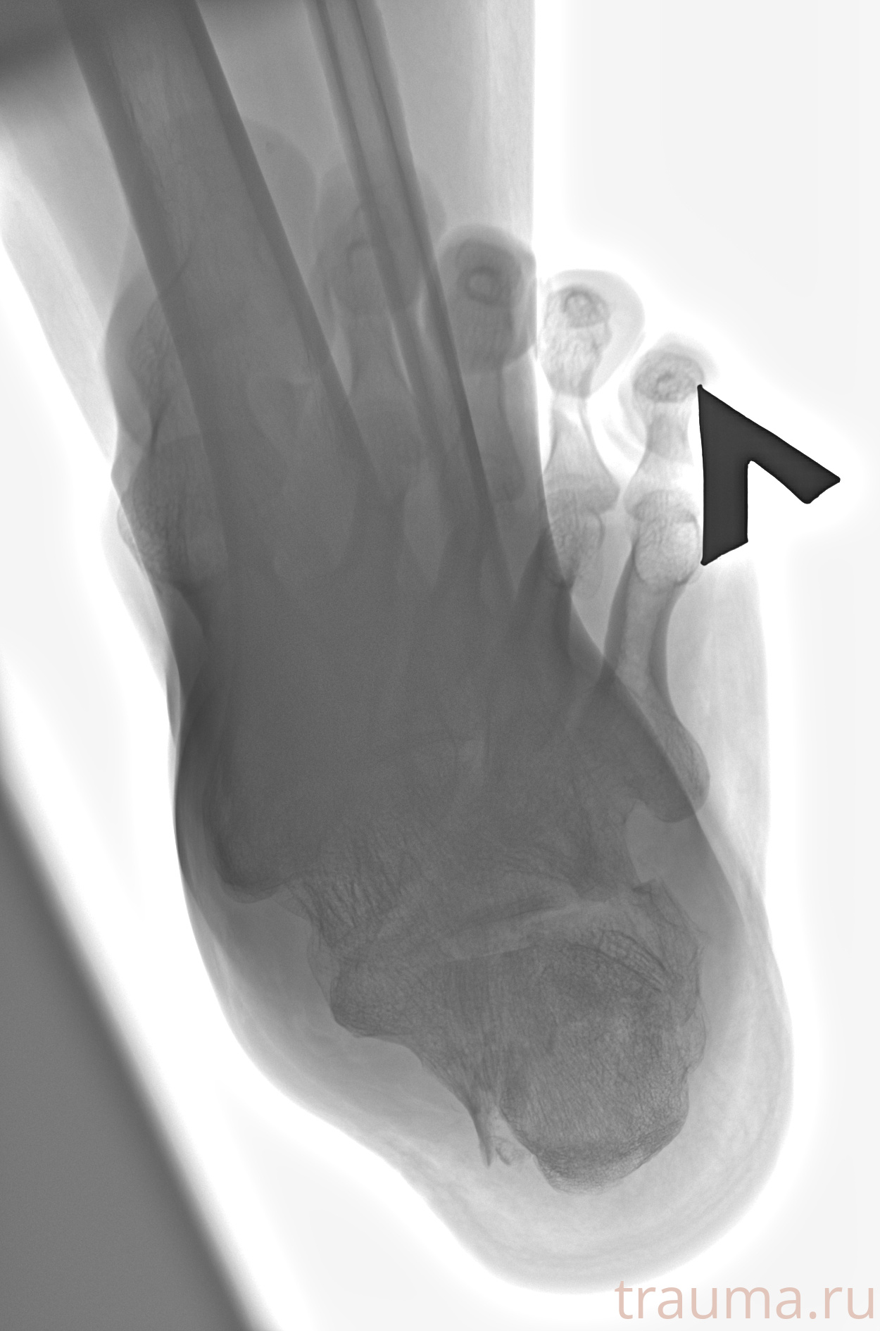 Рентген на дому: по вашему адресу приезжает врач-рентгенолог, травматолог-ортопед с мобильным рентгеновским аппаратом, проводит диагностику травмы или заболевания, делает необходимые рентгенограммы, дает рекомендации по дальнейшему лечению. Получить качественные снимки в домашних условиях возможно благодаря уникальной методике, разработанной МосРентген Центром для института  Склифосовского