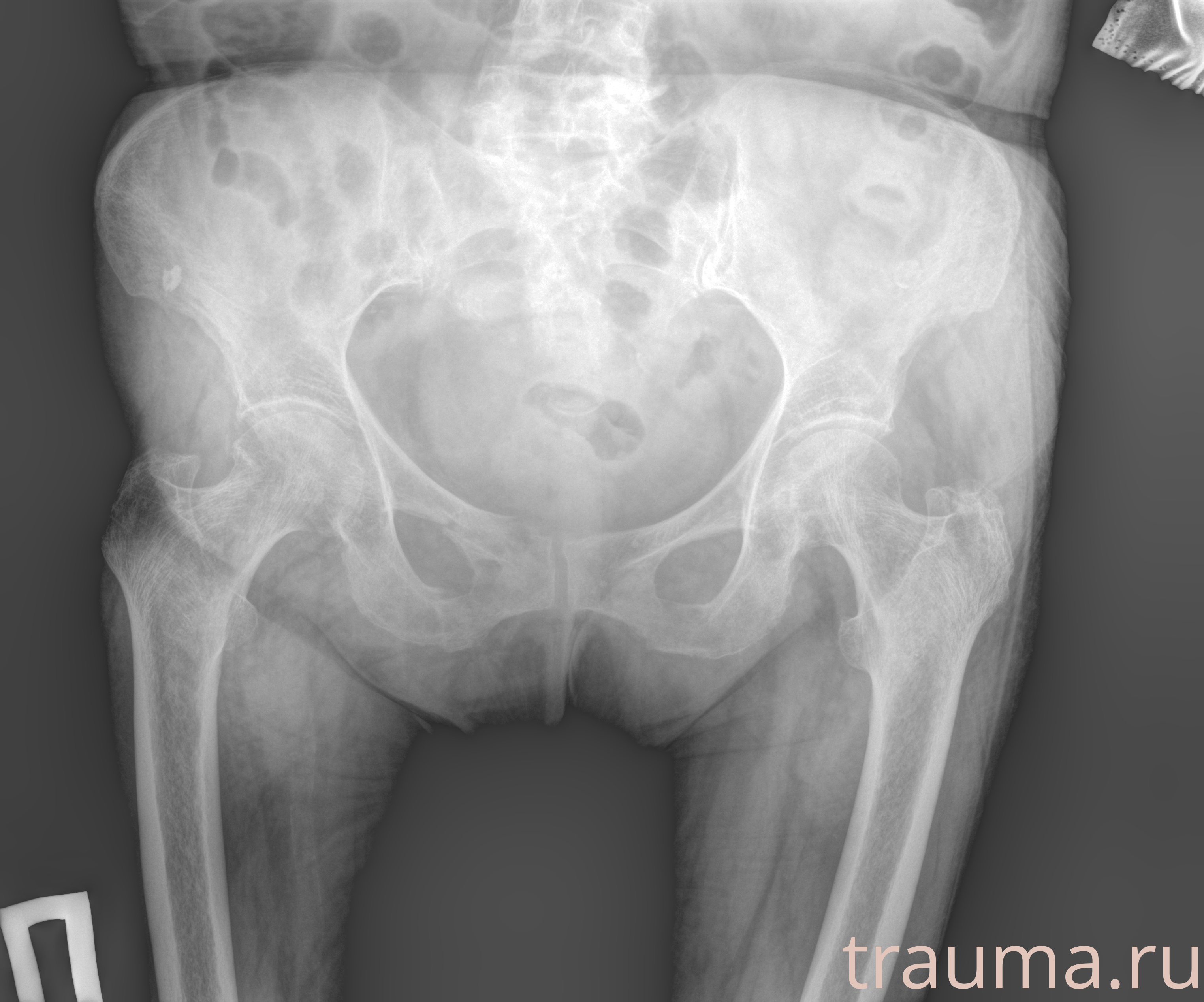 Рентген на дому: по вашему адресу приезжает врач-рентгенолог, травматолог-ортопед с мобильным рентгеновским аппаратом, проводит диагностику травмы или заболевания, делает необходимые рентгенограммы, дает рекомендации по дальнейшему лечению. Получить качественные снимки в домашних условиях возможно благодаря уникальной методике, разработанной МосРентген Центром для института  Склифосовского