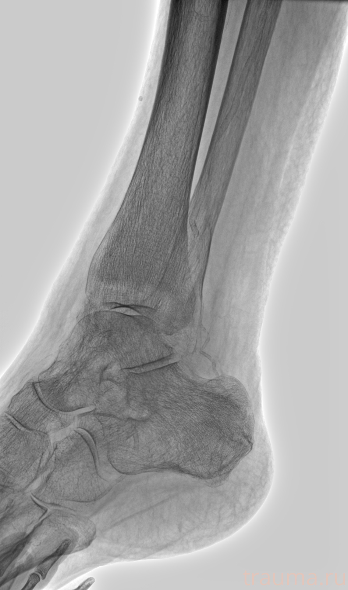 Рентген на дому: по вашему адресу приезжает врач-рентгенолог, травматолог-ортопед с мобильным рентгеновским аппаратом, проводит диагностику травмы или заболевания, делает необходимые рентгенограммы, дает рекомендации по дальнейшему лечению. Получить качественные снимки в домашних условиях возможно благодаря уникальной методике, разработанной МосРентген Центром для института  Склифосовского