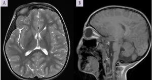 Клинический случай синдрома Миллса