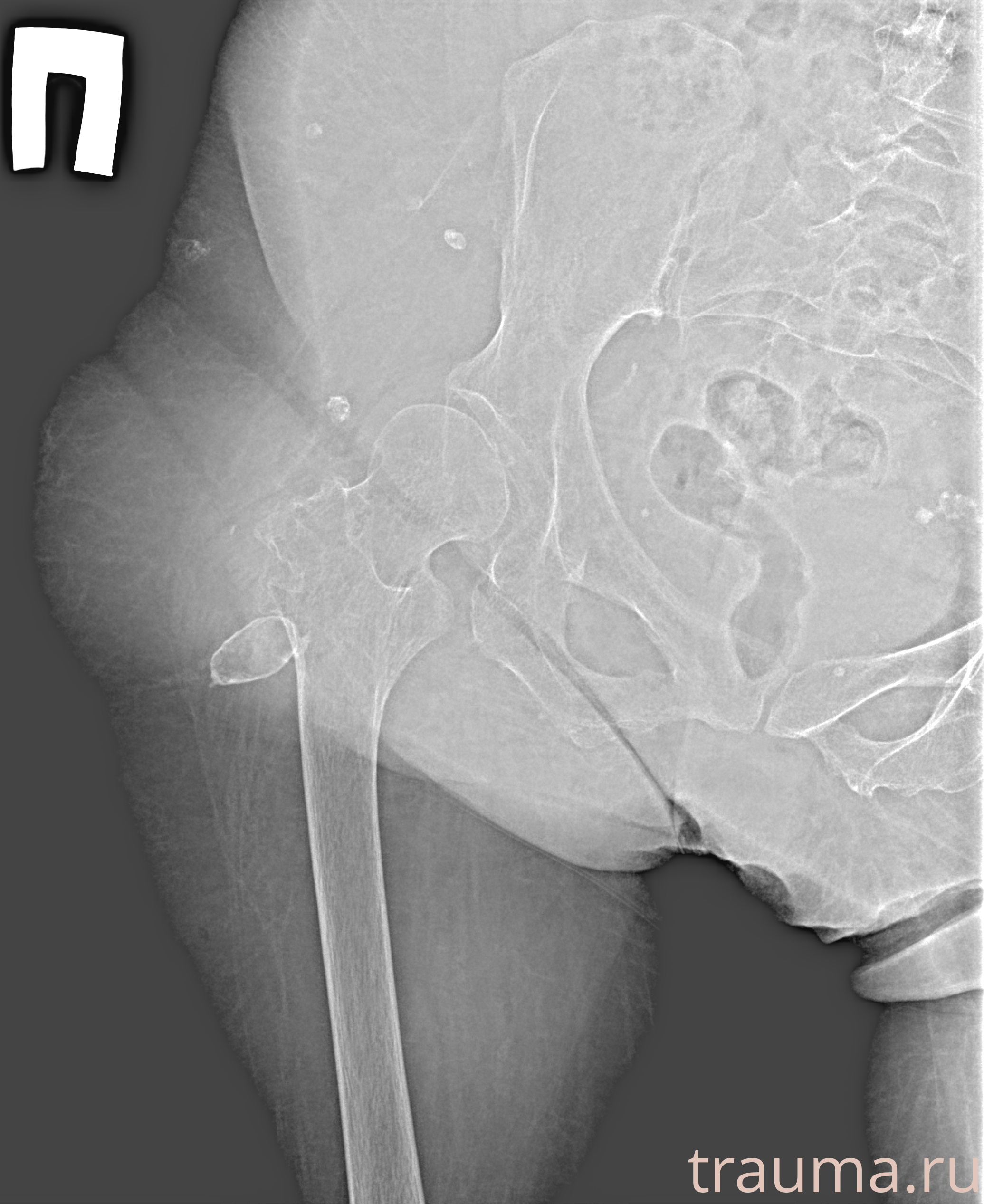Рентген на дому: по вашему адресу приезжает врач-рентгенолог, травматолог-ортопед с мобильным рентгеновским аппаратом, проводит диагностику травмы или заболевания, делает необходимые рентгенограммы, дает рекомендации по дальнейшему лечению. Получить качественные снимки в домашних условиях возможно благодаря уникальной методике, разработанной МосРентген Центром для института  Склифосовского
