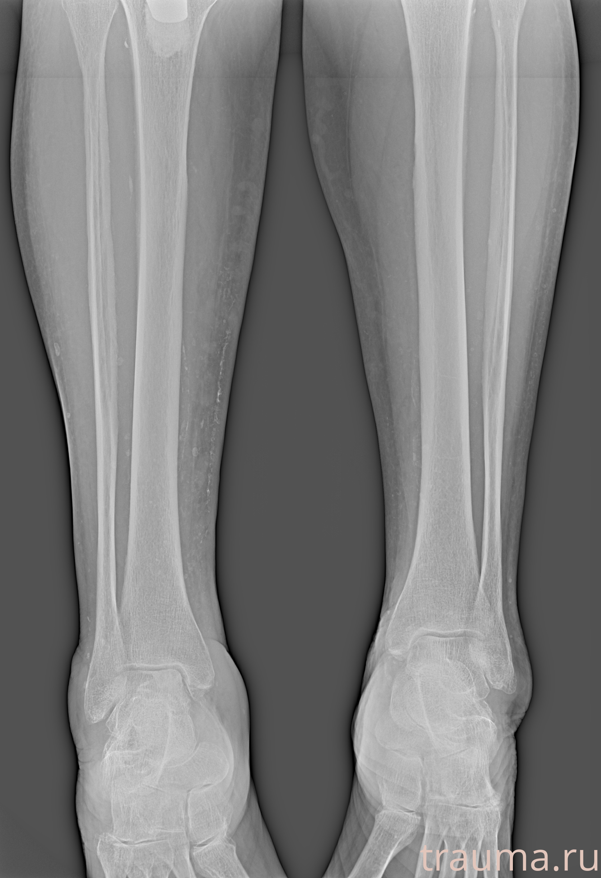 Рентген на дому: по вашему адресу приезжает врач-рентгенолог, травматолог-ортопед с мобильным рентгеновским аппаратом, проводит диагностику травмы или заболевания, делает необходимые рентгенограммы, дает рекомендации по дальнейшему лечению. Получить качественные снимки в домашних условиях возможно благодаря уникальной методике, разработанной МосРентген Центром для института  Склифосовского